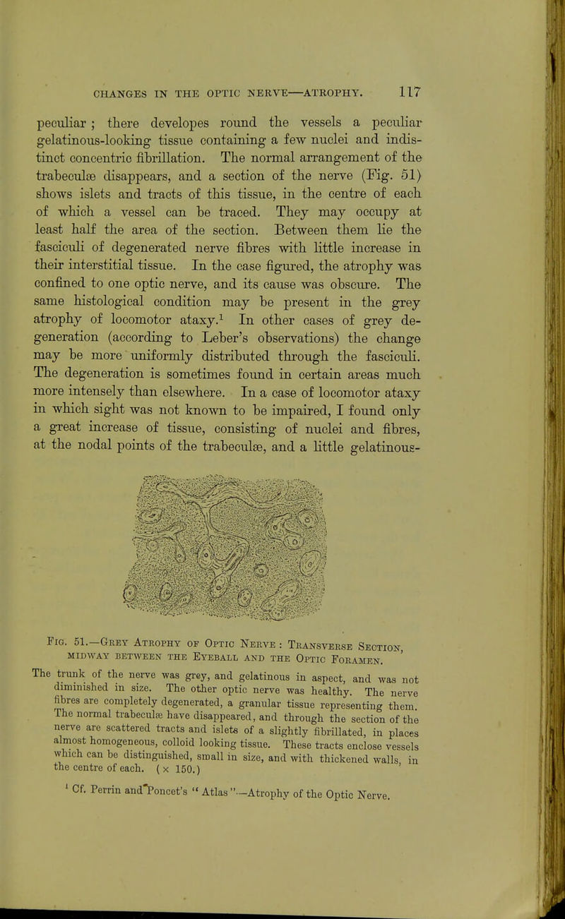 peculiar ; there developes round the vessels a peculiar gelatinous-looking tissue containing a few nuclei and indis- tinct concentric fibrillation. The normal arrangement of the trabeculte disappears, and a section of the nerve (Fig. 51) shows islets and tracts of this tissue, in the centre of each of which a vessel can be traced. They may occupy at least half the area of the section. Between them lie the fasciculi of degenerated nerve fibres with little increase in their interstitial tissue. In the case figured, the atrophy was confined to one optic nerve, and its cause was obscure. The same histological condition may be present in the grey atrophy of locomotor ataxy. ^ In other cases of grey de- generation (according to Leber's observations) the change may be more uniformly distributed through the fasciculi. The degeneration is sometimes found in certain areas much more intensely than elsewhere. In a case of locomotor ataxy in which sight was not known to be impaired, I found only a great increase of tissue, consisting of nuclei and fibres, at the nodal points of the trabeculse, and a little gelatinous- Fig. 51.—Grey Atrophy of Optic Nerve : Transverse Section, MIDWAY between THE EYEBALL AND THE OPTIC FORAMEN. The trunk of the nerve was grey, and gelatinous in aspect, and was not diminished in size. The other optic nerve was healthy. The nerve fibres are completely degenerated, a granular tissue representing them The normal trabecule have disappeared, and through the section of the nerve are scattered tracts and islets of a slightly fibriUated, in places almost homogeneous, colloid looking tissue. These tracts enclose vessels which can be distinguished, small in size, and with thickened walls in the centre of each, (x 150.) ' ' Cf. Perrin and*Poncet's  Atlas -Atrophy of the Optic Nerve.