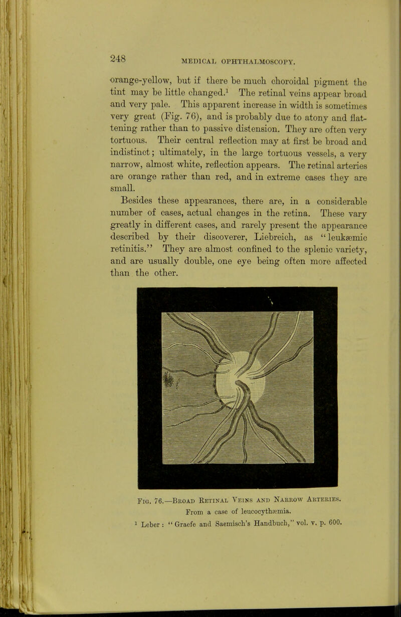 MEDICAL OPHTHALMOSCOPY. orange-yellow, but if there be much choroidal pigment the tint may be little changed.^ The retinal veins appear broad and very pale. This apparent increase in width is sometimes very great (Fig. 76), and is probably due to atony and flat- tening rather than to passive distension. They are often very tortuous. Their central reflection may at first be broad and indistinct; ultimately, in the large tortuous vessels, a very narrow, almost white, reflection appears. The retinal arteries are orange rather than red, and in extreme cases they are small. Besides these appearances, there are, in a considerable number of cases, actual changes in the retina. These vary greatly in different cases, and rarely present the appearance described by their discoverer, Liebreich, as  leukaemic retinitis. They are almost confined to the splenic variety, and are usually double, one eye being often more affected than the other. Fig. 76.—Broad Retinal Veins and Narrow Arteries. From a case of leucocythfemia. 1 Leber :  Graefe and Saemisch's Handbucli, vol. v. p. 600.