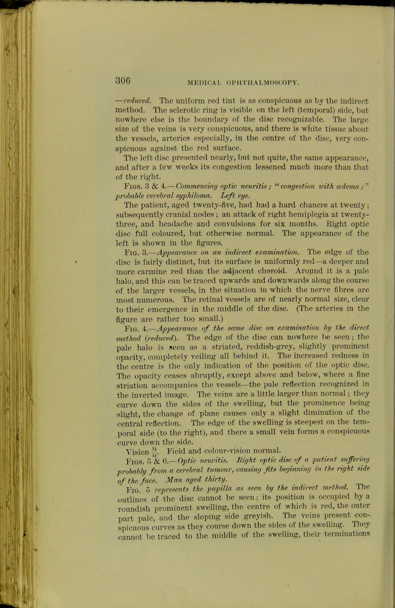 306 —reduced. The uniform red tint is as conspicuous as by the indirect method. The sclerotic ring is visible on the left (temporal) side, but nowhere else is the boundary of the disc recognizable. The large size of tlie veins is very conspicuous, and there is white tissue about the vessels, arteries especially, in the centre of the disc, very con- spicuous against the red surface. The left disc presented nearly, but not quite, the same appearance, and after a few weeks its congestion lessened much more than that of the right. Figs. 3 & 4.—Commencin;/ optic neuritis : congestion iidth oedema; probable cerebral syphiloma. Left eye. The patient, aged twenty-five, had had a hard chancre at twenty; subsequently cranial nodes ; an attack of right hemiplegia at twenty- three, and headache and convulsions for six months. Right optic disc full coloured, but otherwise normal. The appearance of the left is shown in the figures. Fig. 3.—Appearance on an indirect e.vamination. The edge of the disc is fairly distinct, but its surface is uniformly red—a deeper and more carmine red than the adjacent choroid. Aroxmd it is a pale halo, and this can be traced upwards and downwards along the course of the larger vessels, in the situation in which the nerve fibres are most numerous. The retinal vessels are of nearly normal size, clear to their emergence in the middle of the disc. (The arteries in the figm'e are rather too small.) Fig. 4.—Appearance of the same disc on examination by the direct method {reduced). The edge of the disc can nowhere be seen; the pale halo is seen as a striated, reddish-grey, slightly prominent opacity, completely veiling all behind it. The increased redness in the centre is the only indication of the position of the optic disc. The opacity ceases abruptly, except above and below, where a fine istriation accompanies the vessels—the pale reflection recognized in the inverted image. The veins ai*e a little larger than normal; they cm-ve down the sides of the swelling, but the prominence being slight, the change of plane causes only a slight diminution of the central reflection. The edge of the swelling is steepest on the tem- poral side (to the right), and there a small vein forms a conspicuous ■curve down the side. Vision f-. Field and coloiu'-vision normal. Figs. 5 & 6.—Optic neuritis. Right optic disc of a patient suffering probably from a cerebral tumour, causing fits beginning in the right side of the face. Man aged thirty. Fig. 5 represents the papilla as seen by the indirect method. The outlines of the disc cannot be seen; its position is occupied by a roundish prominent swelling, the centre of Avhich is red, the outer part pale, and the sloping side greyish. The veins present con- spicuous curves as they course down the sides of the swelling. Thoy cannot be traced to the middle of the swelling, their terminations I