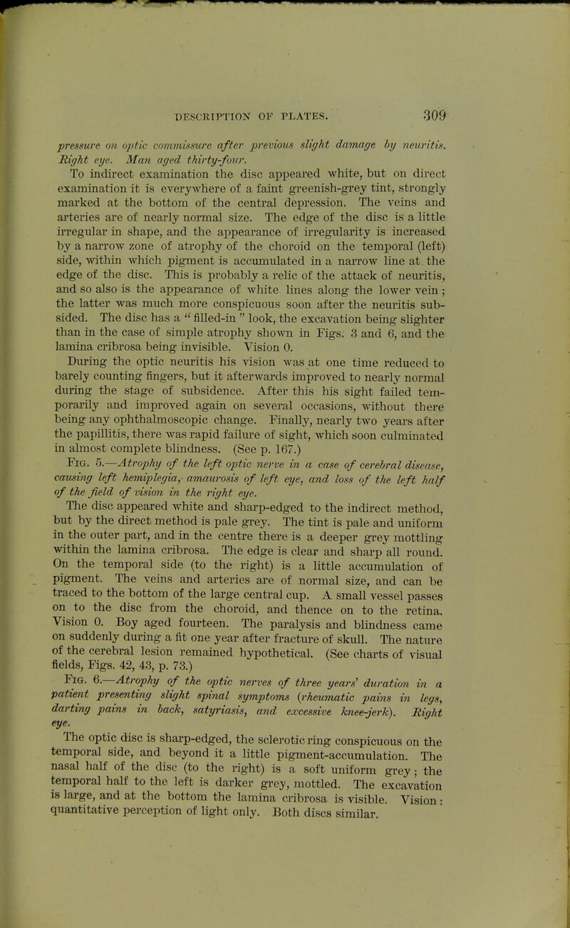 pressure 07i optic commissure after previous slight damage by neuritis. Right eye. Man aged thirty-fonr. To indirect examination the disc appeared white, but on direct examination it is everywhere of a faint greenish-grey tint, strongly marked at the bottom of the central depression. The veins and arteries are of nearly normal size. The edge of the disc is a little irregular in shape, and the appearance of irregularity is increased by a narrow zone of atrophy of the choroid on the temporal (left) side, >vithin which pigment is accumulated in a narrow line at. the edge of the disc. This is probably a relic of the attack of neuritis, and so also is the appearance of white lines along the lower vein ; the latter was much more conspicuous soon after the neuritis sub- sided. The disc has a  filled-in  look, the excavation being slighter than in the case of simple atrophy shown in Figs. 3 and 6, and the lamina cribrosa being invisible. Vision 0. During the optic neuritis his vision was at one time reduced to barely counting fingers, but it afterwards improved to nearly normal during the stage of subsidence. After this his sight failed tem- porarily and improved again on several occasions, mthout there being any ophthalmoscopic change. Finally, nearly two years after the papillitis, there was rapid failure of sight, which soon culminated in almost complete blindness. (See p. 167.) Fig. 6.—Atrophy of the left optic nerve in a case of cerebral disease, causing left hemiplegia, amaurosis of left eye, and loss of the left half of the field of vision in the right eye. The disc appeared white and sharp-edged to the indirect method, but by the direct method is pale gi-ey. The tint is pale and uniform in the outer part, and in the centre there is a deeper grey mottling within the lamina cribrosa. The edge is clear and sharp all round. On the temporal side (to the right) is a little accumulation of pigment. The veins and arteries are of normal size, and can be traced to the bottom of the large central cup. A small vessel passes on to the disc from the choroid, and thence on to the retina. Vision 0. Boy aged fourteen. The paralysis and blincbiess came on suddenly during a fit one year after fracture of skull. The nature of the cerebral lesion remained hypothetical. (See charts of visual fields, Figs. 42, 43, p. 73.) Fig. Q.—Atrophy of the optic nerves of three years' duration in a patient presenting slight spinal symptoms {rheumatic pains in legs, darting pains in back, satyriasis, and cvcessive knee-Jerk). Eight eye. The optic disc is sharp-edged, the sclerotic ring conspicuous on the temporal side, and beyond it a little pigment-accumulation. The nasal half of the disc (to the right) is a soft uniform grey; the temporal half to the left is darker grey, mottled. The excavation is large, and at the bottom the lamina cribrosa is visible. Vision: quantitative perception of light only. Both discs similar.