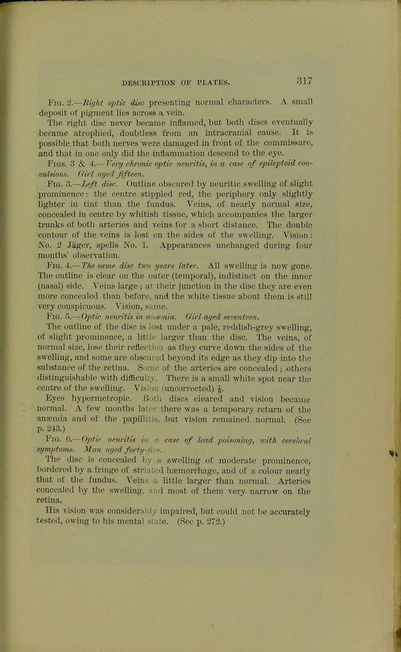 Fig. -2.—Eiff?it optic (^c presenting normal characters. A small deposit of pigment lies across a vein. The right disc never became inflamed, but both discs eventually became atrophied, doubtless from an intracranial cause. It is possible that both nerves were damaged in front of the commissure, and that in one only did the inflammation descend to the eye. Figs. 3 & 4.— Veiy chronic optic neuritis, in a case of epileptoid con- vulsions. Girl aged fifteen. , Fig. 3.—Left disc. Outline obscured by neui'itic swelling of slight prominence: the centre stippled red, the periphery only slightly lighter in tint than the fundus. Veins, of nearly normal size, concealed in centre by whitish tissue, which accompanies the lai'ger trunks of both arteries and veins for a short distance. The double contou^r of tlie veins is lost on the sides of the swelling. Vision: No. 2 Jiiger, spells No. I. Appearances unchanged during four months' observation. Fig. 4.— The same disc tivo years later. All swelling is now gOne. The outline is clear on the outer (temporal), indistinct on the inner (nasal) side. Veins large ; at their junction in the disc they are even more concealed than before, and the white, tissue about them is still very conspicuous. Vision, same. Fig. 6.—Optic neuritis in ansemia. Girl aged seventeen. The outline of the disc is lost under a pale, redcUsh-grey swelling, of shght larominence, a little larger than the disc. The veins, of normal size, lose their reflection as they curve down the sides of the swelling, and some are obscured beyond its edge as they dip into the substance of the retina. Some of the arteries are concealed ; others distinguishable with difBcullv. There is a small white spot near the centre of the swelling. Vision (uncorrected) |. Eyes hypermetropic. Both discs cleared and vision became normal. A few months later there was a temporary return of the ansemia and of the papillitis, but vision remained normal. (See p. 243.) Fig. 0.—Optic neuritis in a case of lead poisoning, with cerebral symptoms. Man aged forty-five. The disc is concealed by a swelling of moderate prominence, bordered by a fringe of stri;it;od hjemorrhage, and of a colour nearly that of the fundus. Veins a little larger than normal. Arteries concealed by the swelling, and most of them very narrow on the retina. His vision was consideral)ly impaired, but could not be accurately tested, owing to his mental state. (Sec p. 272.)