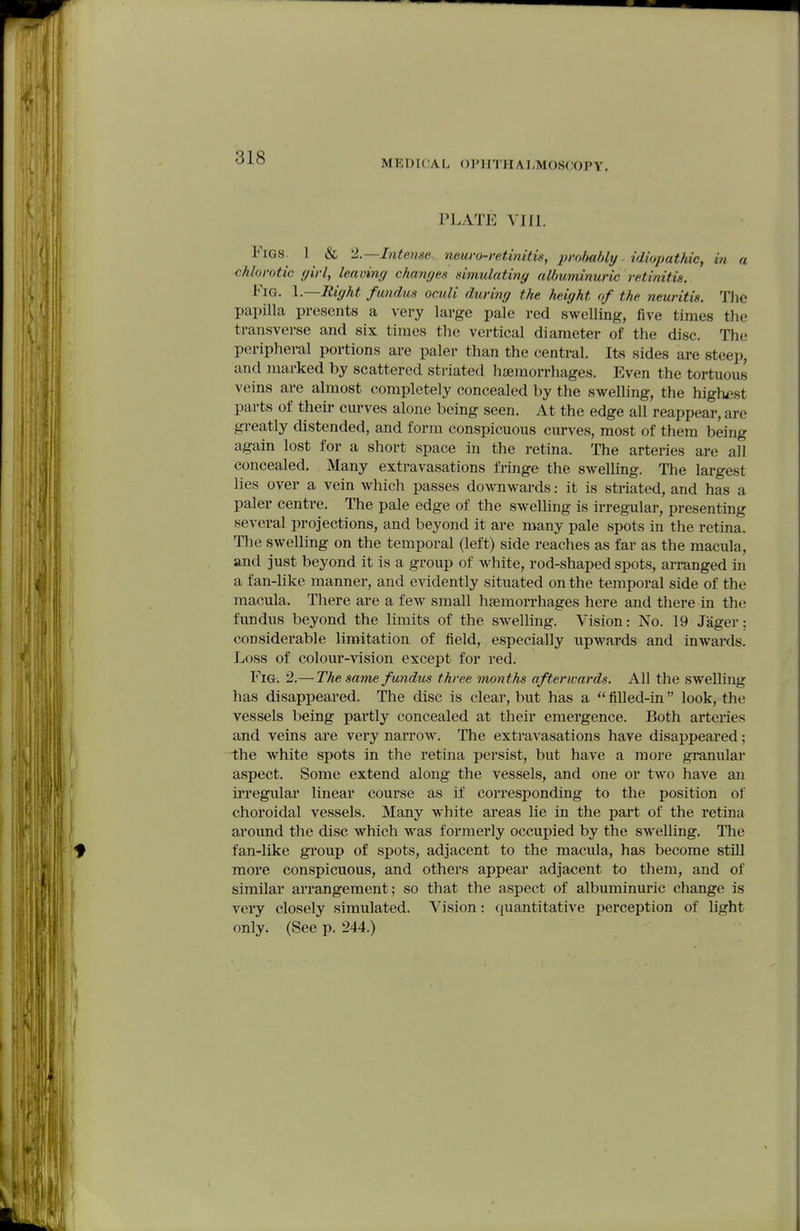 MEDIOAL OPHTHALMOSCOPY. PLATE VIII. Figs. 1 & %—Intense, neuro-retinitis, probably - idiopathic, in a chlorotic <jirl, leaving changes simulatiny albuminuric retinitis. Fig. l.—Jtiffht fundus oculi during the height of the neuritis. TJie papilla presents a very large pale red swelling, five times the transverse and six times the vertical diameter of the disc. The peripheral portions are paler than the central. Its sides are steep, and marked by scattered striated haemorrhages. Even the tortuous veins are almost completely concealed by the swelling, the highest parts of their curves alone being seen. At the edge all reappear, are greatly distended, and form conspicuous ciu-ves, most of them being again lost for a short space in the retina. The arteries are all concealed. Many extravasations fringe the swelling. The largest lies over a vein which passes do%\Tiwards: it is striated, and has a paler centre. The pale edge of the SAvelling is irregular, presenting several projections, and beyond it are many pale spots in the retina. The swelling on the temporal (left) side reaches as far as the macula, and just beyond it is a group of white, rod-shaped spots, arranged in a fan-like manner, and evidently situated on the temporal side of the macula. There are a few small haemorrhages here and there in the fundus beyond the limits of the swelling. Vision: No. 19 Jager; considerable limitation of field, especially upwards and iuAvards. Loss of colour-vision except for red. Fig. 2.—The same fundus three months afterwards. All the swelling has disappeared. The disc is clear, but has a  fiUed-in look, the vessels being partly concealed at their emergence. Both arteries and veins are very narrow. The extravasations have disappeared; i;he white spots in the retina persist, but have a moi*e granular aspect. Some extend along the vessels, and one or two have an ii'regular linear course as if corresponding to the position of choroidal vessels. Many white areas lie in the part of the retina around the disc which was formerly occupied by the swelling. The fan-like group of spots, adjacent to the macula, has become still more conspicuous, and others appear adjacent to them, and of similar arrangement; so that the aspect of albuminuric change is very closely simulated. Vision: quantitative perception of light only. (See p. 244.)