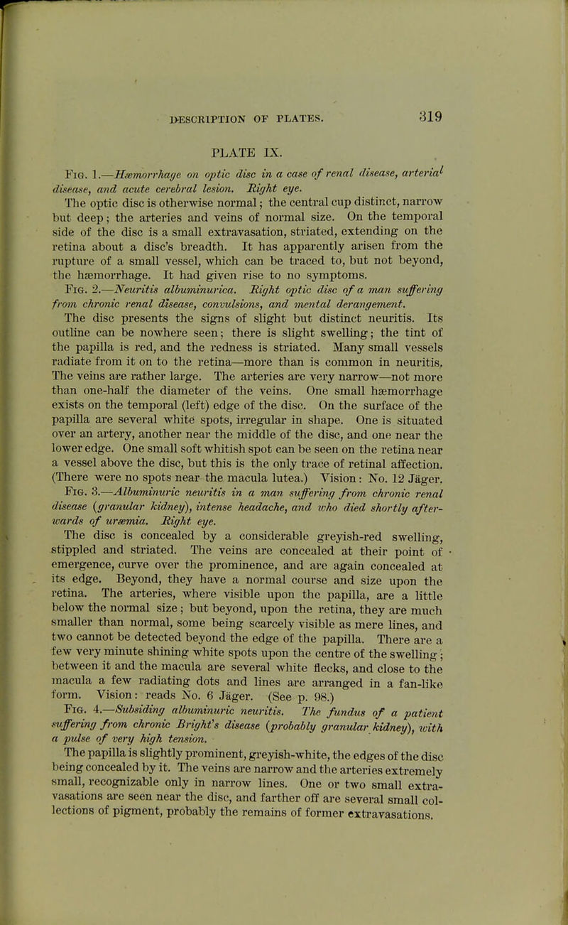 f 1>ESCR1PTI0N OF PLATES. 319 PLATE IX. Fig. 1.—Haemorrhage on optic disc in a case of renal diaease, arteria^ disease, and acute cerebral lesion. Right eye. The optic disc is otherwise normal; the central cup distinct, narrow but deep; the arteries and veins of normal size. On the temporal side of the disc is a small extravasation, striated, extending on the retina about a disc's breadth. It has apparently arisen from the ruptiu'e of a small vessel, which can be traced to, but not beyond, the haemorrhage. It had given rise to no symptoms. Fig. 2.—Neuritis albuminurica. Right optic disc of a man suffering from chronic renal disease, convulsions, and mental derangement. The disc presents the signs of slight but distinct neuritis. Its outline can be nowhere seen; there is slight swelling; the tint of the papilla is red, and the redness is striated. Many small vessels radiate from it on to the retina—more than is common in neuritis. The veins are rather large. The arteries are very narrow—not more than one-half the diameter of the veins. One small haemorrhage exists on the temporal (left) edge of the disc. On the surface of tlie papilla are several white spots, irregular in shape. One is situated over an artery, another near the middle of the disc, and one near the lower edge. One small soft whitish spot can be seen on the retina near a vessel above the disc, but this is the only trace of retinal affection. (There were no spots near the macula lutea.) Vision: No. 12 Jager, Fig. 3.—Albuminuric neuritis in a man suffering from chronic renal disease {granular kidney), intense headache, and ivho died shortly after- wards of ursemia. Right eye. The disc is concealed by a considerable greyish-red swelling, stippled and striated. The veins are concealed at their point of emergence, curve over the prominence, and are again concealed at its edge. Beyond, they have a normal course and size upon the retina. The arteries, Avhere visible upon the papilla, are a little below the normal size; but beyond, upon the retina, they are much smaller than normal, some being scarcely visible as mere lines, and two cannot be detected beyond the edge of the papilla. There are a few very minute shining white spots upon the centre of the swelling • between it and the macula are several white flecks, and close to the macula a few radiating dots and lines are arranged in a fan-like form. Vision: reads No. 6 Jager. (See p. 98.) Fig. 4.—Subsiding albuminuric neuritis. The fundus of a patient .mffering from chronic Bright's disease {probably granular kidney), with a pulse of very high tension. The papilla is sUghtly prominent, greyish-white, the edges of the disc being concealed by it. The veins are narrow and the arteries extremely small, recognizable only in narrow lines. One or two small extra- vasations are seen near the disc, and farther off are several small col- lections of pigment, probably the remains of former extravasations.