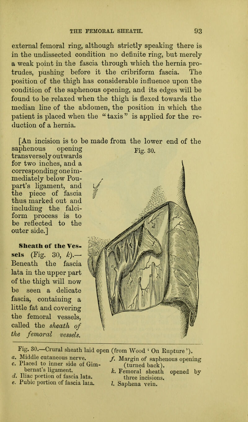 external femoral ring, although strictly speaking there is in the undissected condition no definite ring, but merely a weak point in the fascia through which the hernia pro- trudes, pushing before it the cribriform fascia. The position of the thigh has considerable influence upon the condition of the saphenous opening, and its edges will be found to be relaxed when the thigh is flexed towards the median line of the abdomen, the position in which the patient is placed when the  taxis  is applied for the re- duction of a hernia. [An incision is to be made from the lower end of the saphenous opening transversely outwards for two inches, and a corresponding one im- mediately below Pou- part's ligament, and the piece of fascia thus marked out and including the falci- form process is to be reflected to the outer side.] Sheath of the Ves- sels (Fig. 30, £).— Beneath the fascia lata in the upper part of the thigh will now be seen a delicate fascia, containing a little fat and covering the femoral vessels, called the sheath of the femoral Fig. 30. Fig. 30.—Crural sheath laid open (from Wood ' On Kupture '). a. Middle cutaneous nerve. /. Margin of saphenous opening c. Placed to inner side of Gim- (turned back). bernat's ligament. k. Femoral sheath opened by d. Iliac portion of fascia lata. three incisions. e. Pubic portion of fascia lata. I. Saphena vein.