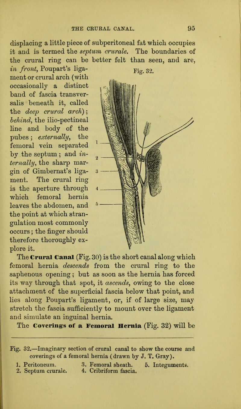 displacing a little piece of subperitoneal fat which occupies it and is termed the septum crurale. The boundaries of the crural ring can be better felt than seen, and are, in front, Poupart's liga- ment or crural arch (with occasionally a distinct band of fascia transver- salis beneath it, called the deep crural arch); behind, the ilio-pectineal line and body of the pubes; externally, the femoral vein separated by the septum ; and in- ternally, the sharp mar- gin of Gimbernat's liga- 3 ment. The crural ring is the aperture through 4 which femoral hernia leaves the abdomen, and h the point at which stran- gulation most commonly occurs; the finger should therefore thoroughly ex- plore it. The Crural Canal (Fig. 30) is the short canal along which femoral hernia descends from the crural ring to the saphenous opening ; but as soon as the hernia has forced its way through that spot, it ascends, owing to the close attachment of the superficial fascia below that point, and lies along Poupart's ligament, or, if of large size, may stretch the fascia sufficiently to mount over the ligament and simulate an inguinal hernia. The Coverings of a Femoral Hernia (Fig. 32) will be Fig. 32.—Imaginary section of crural canal to show the course and coverings of a femoral hernia (drawn by J. T. Gray). 1. Peritoneum. 3. Femoral sheath. 5. Integuments. 2. Septum crurale. 4. Cribriform fascia.
