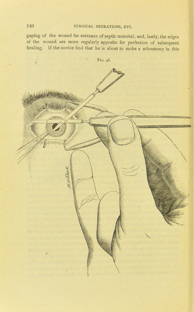 gaping of the wound for entrance of septic material, and, lastly, the edges of the wound are more regularly apposite for perfection of subsequent healing. If the novice find that he is about to make a sclerotomy in this Fig. 46.