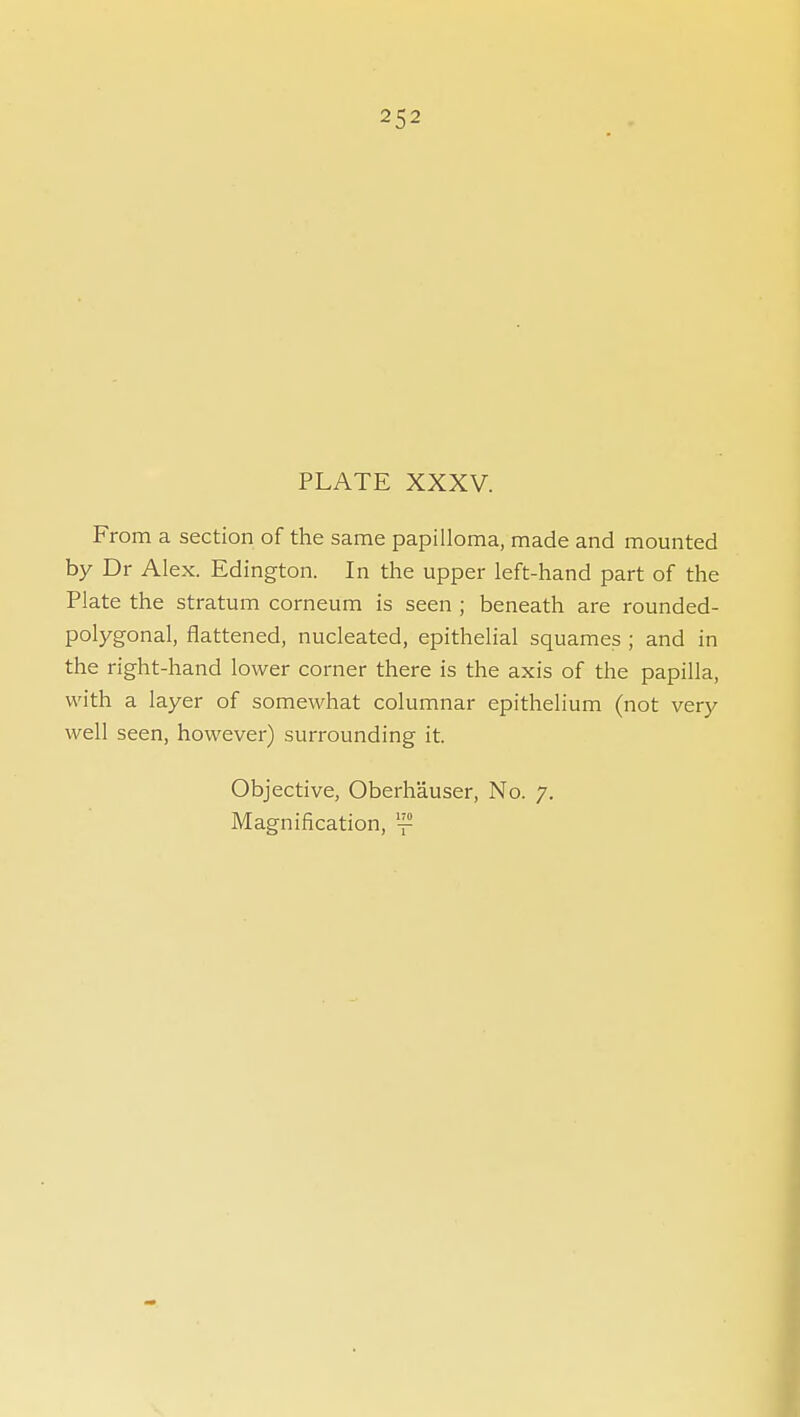 252 PLATE XXXV. From a section of the same papilloma, made and mounted by Dr Alex. Edington. In the upper left-hand part of the Plate the stratum corneum is seen ; beneath are rounded- polygonal, flattened, nucleated, epithelial squames ; and in the right-hand lower corner there is the axis of the papilla, with a layer of somewhat columnar epithelium (not very well seen, however) surrounding it. Objective, Oberhauser, No. 7. Magnification, '-^ 1