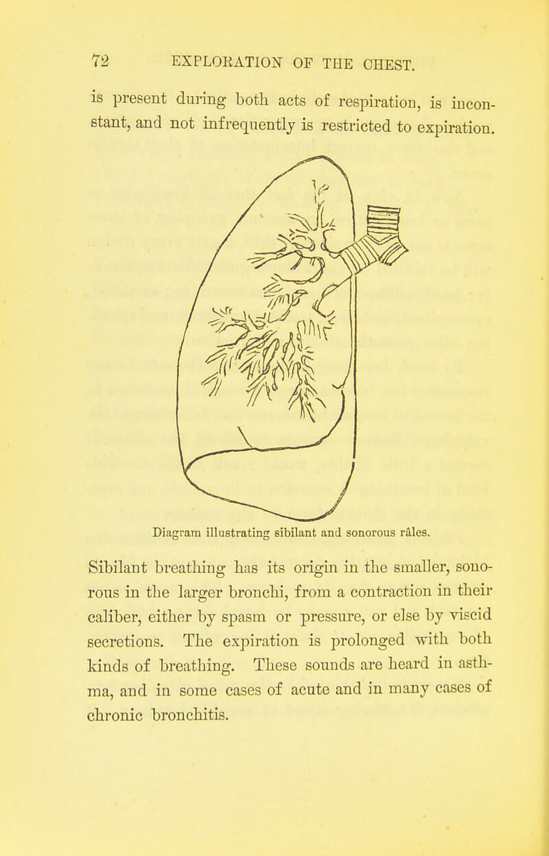 is present during both acts of respiration, is incon- stant, and not infrequently is restricted to expiration. Diagram illustrating sibilant and sonorous rS,les. Sibilant breathing has its origin in the smaller, sono- rous in the larger bronchi, from a contraction in their caliber, either by spasm or pressure, or else by viscid secretions. The expiration is prolonged with both kinds of breathing. These sounds are heard in asth- ma, and in some cases of acute and in many cases of chronic bronchitis.