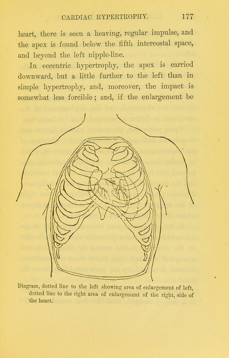 CARDIAC HYPERTPwOPHY. m heart, there is seen a heaving, regular impulse, and the apex is found below the hfth intercostal space, and beyond the left nipple-line. In eccentric hypertrophy, the apex is carried downward, but a little further to the left than in simple hypertrophy, and, moreover, the impact is somewhat less forcible; and, if the enlargement be Diagram, dotted line to the left showing area of enlargement of left, dotted line to the right area of enlargement of the right, side of the heart.