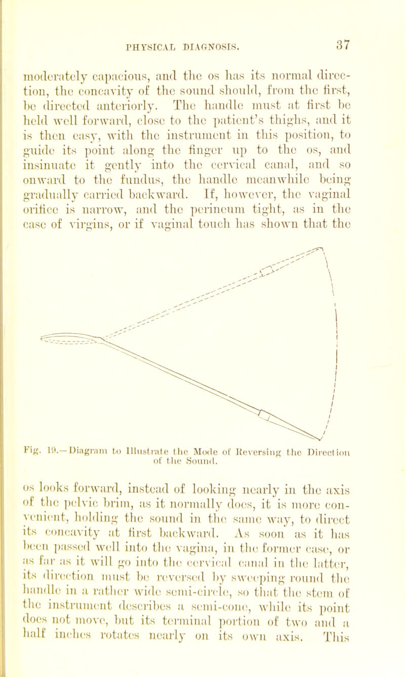 moderately capacious, and the os has its normal direc- tion, the concavity of the sound should, from the first, he directed anteriorly. The handle must at first he held well forward, close to the patient's thighs, and it is then easy, with the instrument in this position, to guide its point along the finger up to the os, and insinuate it gently into the cervical canal, and so onward to the fundus, the handle meanwhile heing gradually carried backward. If, however, the vaginal orifice is narrow, and the perineum tight, as in the case of virgins, or if vaginal touch luis shown that the Fif;. 19.—Diagram to Ilhist nite t he Mode of lievcrsiiiK the Direct ion of the Souiiil. OS looks forward, instead of looking nearly in the axis of the pelvic brim, as it normally does, it is uiore con- venient, holding the sound in the same wtiy, to direct its concavity at first backward. iVs soon as it lias been passed well into tlie vaginti, in tlie fornu'r case, or as far as it will go into thv. cervical canal in the latter, its direction must be reversed liy swec])ing toiukI tlie handle in a ratlier wide semi-circh;, so that the stem of the instrument describes a semi-coiK!, while its point does not move, but its terminal portion of two and a ludf inches rotates nearly on its own axis. This