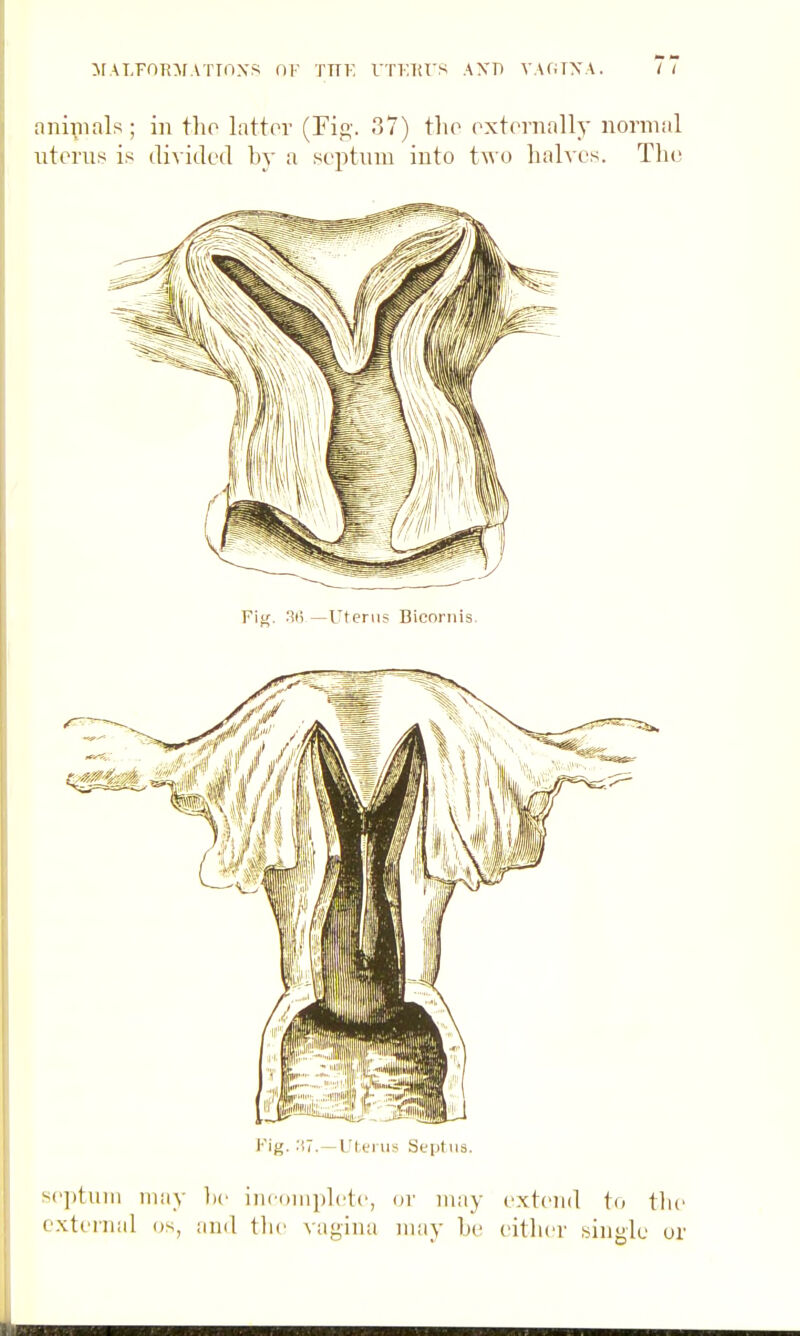 ^[ALFOI^:^rATTn^•s ni' tfk VTinu's axd vaotxa. i i anipials; in tho latter (Fig. 37) tho oxternally normal uterus is divided bj' a septum into two halves. The Fi^. 3ii —Uterus Bicoriiis. ^e])tiiin may he iiicDiiiplete, or may extend to tlie external os, and tlie vagina nuiy he either singlu or 1