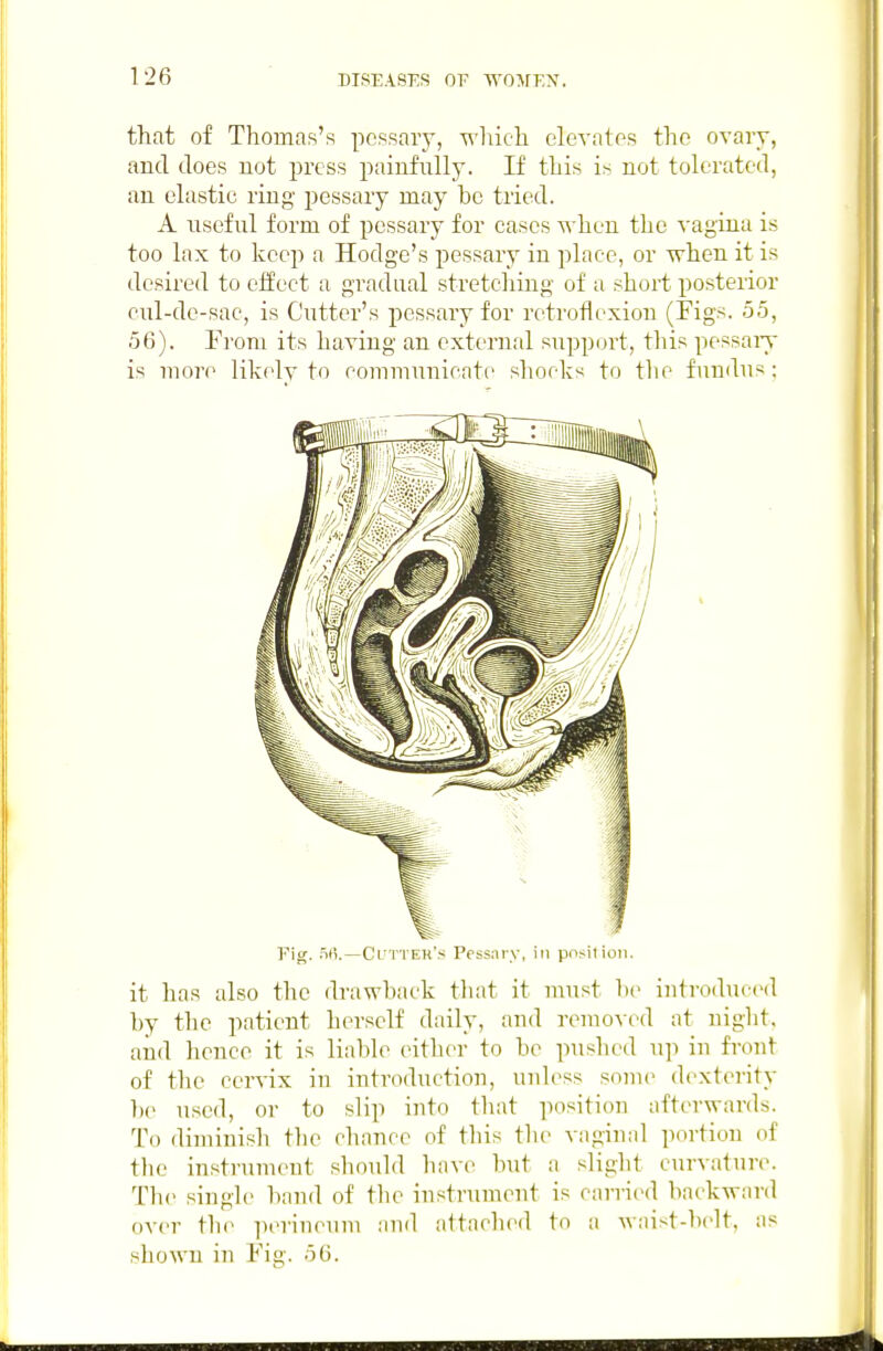 that of Thomas's pessary, wliich clcA'atos the ovary, and does not press painfully. If this is not tolerated, an elastic ring pessary may be tried. A useful form of pessary for cases T\-hen the vagina is too lax to keep a Hodge's pessary in place, or when it is desired to effect a gradual stretching of a short posterior cul-de-sac, is Cutter's pessary for retroflexion (Figs. 55, 56). From its having an external support, tliis pessaiy is more likely to communicate shocks to tlie fundus; Fig. .W.—Cl'TTEh's Pessary, in posilioii. it has also the drawback that it u\ust he introduced by the patient herself daily, and removed at night, and lience it is liable either to be pushed up in front of the cervix in introduction, unless souu' dexterity be used, or to slip into that position afterwards. To diminish tlie chance of tliis tlie vaginal portion of the instrument should have but a slight curvature. The single band of tlie instrument is carried backward over the perineum and attached to a waist-])elt, as shown in Fig. 56.