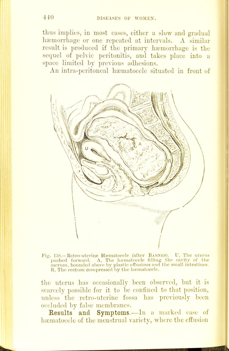 thus implies, iu most cases, either a slow and gradual hajmorrhagc or one repeated at intervals. A similar result is produced if the primary haemorrhage is the sequel of pehic peritonitis, and takes place into a space limited hy previous adhesions. An intra-peritoneal htematoccle situated in front of Fi^'. IIJH.—lletro-utoriue Hirinaloci'lc (after BAHNiiS). U, The \itcnis pushed forwaril. A, The lia'iiiatdeele lilliiif; the eavify of Ihe sacrum, bounded above liy plast ic effusions and the small iiitestiues. K, The rectum compressed l)y the luvmatocele. tlie uterus has occasionally been observed, but it is scarcely possible for it to be confined to that position, unless the retro-uterine fossa has previously been occluded liy false membranes. Results and Symptoms.—In .i maiked lase of hycmatocele of the menstrual varii'ty, Avlu^re the effusion