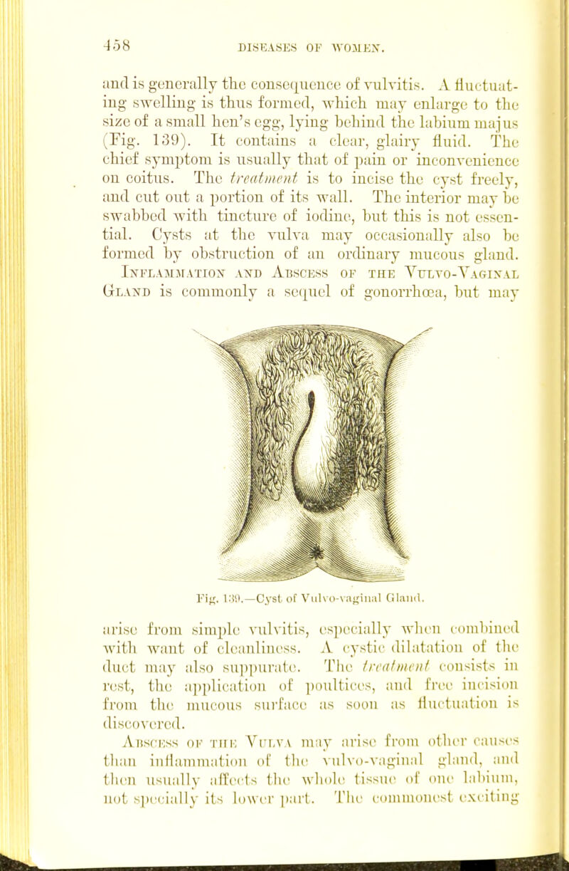 and is generally the consequence of vulvitis. A liuctuat- ing swelling is thus formed, which may enlarge to the size of a small hen's egg, lying hehind the labium majus (Fig. 139). It contains a clear, glairy fluid. The chief symj^tom is usually that of pain or inconvenience on coitus. The treatment is to incise the cyst freely, and cut out a portion of its wall. The interior may he swabbed with tincture of iodine^, but this is not essen- tial. Cysts at tlie vulva may occasionally also be formed by obstruction of an ordinary mucous gland. Inflamjiatiox and Abscess of the Yulvo-Vagixal Gland is commonly a se(][uel of gonorrhosa, but may Fii;. l.'W.—Cyst of Vulvo-vaginal Glnnd. arise from simple vulvitis, I'specially wlien eomlnued Avith want of cleanliness. A cystic dilatation of the duct may also su])purat(>. The treat moil consists in rest, the application of poultices, and free incision from the mucous surface as soon as fluctuation is discovered. Abscess of tim'. Vrr.vv may arise from other causes than inflammation of the vulvo-vaginal gland, and tlic^n usually aifects the wlioh; tissue of one lal)ium, not s])ecially its lower part. Tlie commonest exciting