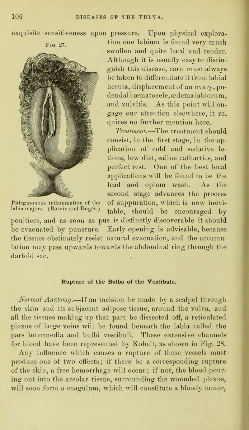 Fig. 27. exquisite sensitiveness upon pressure. Upon physical explora- tion one labium is found very much swollen and quite hard and tendei\ Although it is usually easy to distin- guish this disease, care must always be taken to differentiate it from labial hernia, displacement of an ovary, pu- dendal hematocele, oedema labiorum, and vulvitis. As this point will en- gage our attention elsewhere, it re. quires no further mention here. Treatment.—The treatment should consist, in the first stage, in the ap- plication of cold and sedative lo- tions, low diet, saline cathartics, and perfect rest. One of the best local applications will be found to be the lead and opium wash. As the second stage advances the process of suppuration, which is now inevi- table, should be encouraged by poultices, and as soon as pus is distinctly discoverable it should be evacuated by puncture. Early opening is advisable, because the tissues obstinately resist natural evacuation, and the accumu- lation may pass upwards towards the abdominal ring through the dartoid sac. Phlegmonous inflammation of the labia majora. (Boivin and Dug^s.) Rupture of the Bulbs of the Vestibule. Normal Anatomy.—If an incision be made by a scalpel through the skin and its subjacent adipose tissue, around the vulva, and all the tissues making up that part be dissected oft, a reticulated plexus of large veins will be found beneath the labia called the pars intermedia and bulbi vestibuli. These extensive channels for blood have been represented by Kobelt, as shown in Fig. 28. Any influence which causes a rupture of these vessels must produce one of two effects; if there be a corresponding rupture of the skin, a free hemorrhage will occur; if not, the blood pour- ing out into the areolar tissue, surrounding the wounded plexus, will soon form a coagulum, which will constitute a bloody tumor,