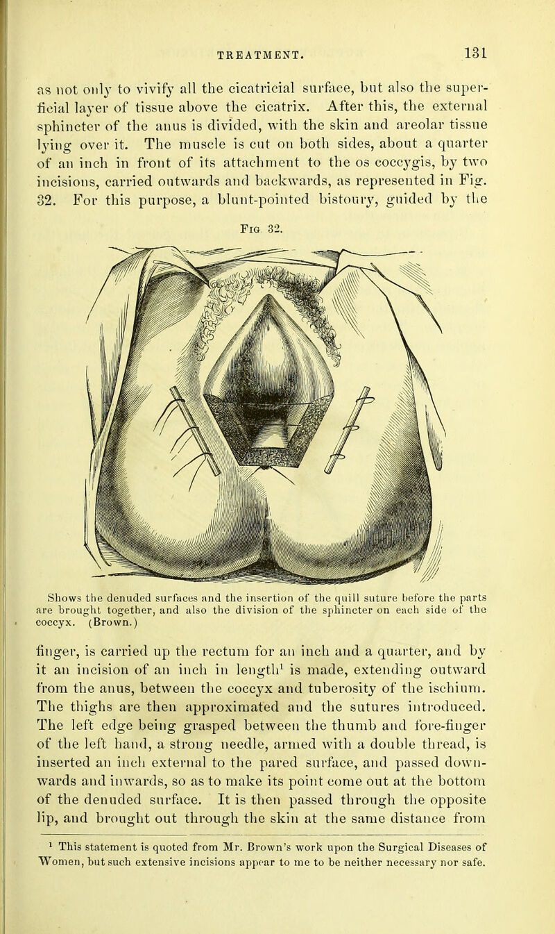 as not only to vivify all the cicatricial surface, but also the super- ficial layer of tissue above the cicatrix. After this, the external sphincter of the anus is divided, with the skin and areolar tissue lying over it. The muscle is cut on both sides, about a quarter of at) inch in front of its attachment to the os coccygis, by two incisions, carried outwards and backwards, as represented in Fig. 32. For this purpose, a blunt-pointed bistoury, guided by the Fig 32. Shows the denuded surfaces and the insertion of the quill suture before the parts are brought together, and also the division of the sphincter on each side of the coccyx. (Brown.) finger, is carried up the rectum for an inch and a quarter, and by it an incision of an inch in length1 is made, extending outward from the anus, between the coccyx and tuberosity of the ischium. The thighs are then approximated and the sutures introduced. The left edge being grasped between the thumb and fore-finger of the left hand, a strong needle, armed with a double thread, is inserted an inch external to the pared surface, and passed down- wards and inwards, so as to make its point come out at the bottom of the denuded surface. It is then passed through the opposite lip, and brought out through the skin at the same distance from 1 This statement is quoted from Mr. Brown's work upon the Surgical Diseases of Women, but such extensive incisions appear to me to be neither necessary nor safe.