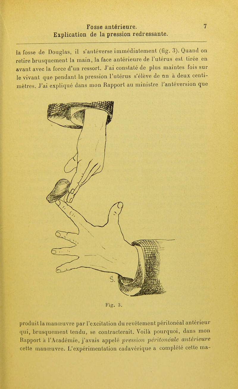 Explication de la pression redressante. la fosse de Douglas, il s'antéverse immédiatement (fig. 3). Quand on retire brusquement la main, la face antérieure de l'utérus est tirée en avant avec la force d'un ressort. J'ai constaté de plus maintes fois sur le vivant que pendant la pression l'utérus s'élève de tin à deux centi- mètres. J'ai expliqué dans mon Rapport au ministre l'antéversion que Fig. 3. produit la manœuvre par l'excitation du revêtement péritonéal antérieur qui, brusquement tendu, se contracterait. Voilà pourquoi, dans mon Rapport à l'Académie, j'avais appelé pression péritonéale antérieure cette manœuvre. L'expérimentation cadavérique a complété celte ma-