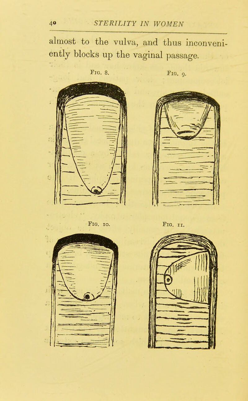 almost to the vulva, and thus inconveni- ently blocks up the vaginal passage. Fio. 8. Fig, 9. Fig. 10. Fig. II.