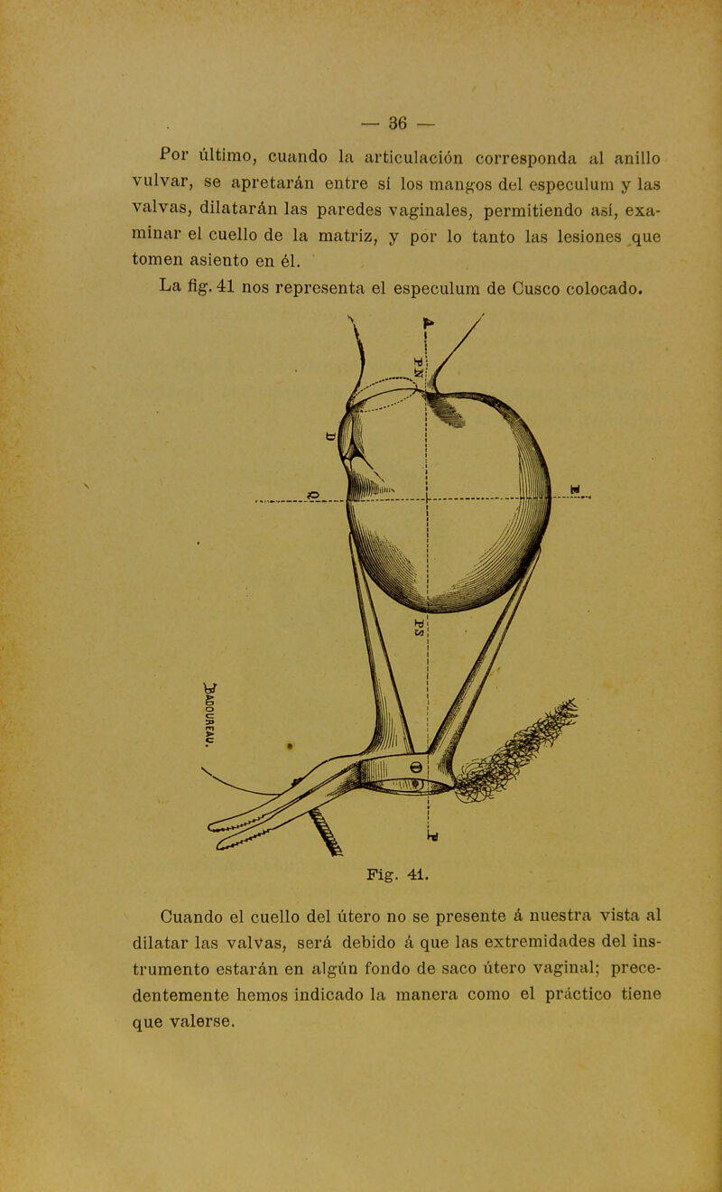 Por último, cuando la articulación corresponda al anillo vulvar, se apretarán entre sí los mangos del especulura y las valvas, dilatarán las paredes vaginales, permitiendo así, exa- minar el cuello de la matriz, y por lo tanto las lesiones que tomen asiento en él. La fig. 41 nos representa el especulum de Cusco colocado. Fig. 41. Cuando el cuello del útero no se presente á nuestra vista al dilatar las valvas, será debido á que las extremidades del ins- trumento estarán en algún fondo de saco útero vaginal; prece- dentemente hemos indicado la manera como el práctico tiene que valerse.