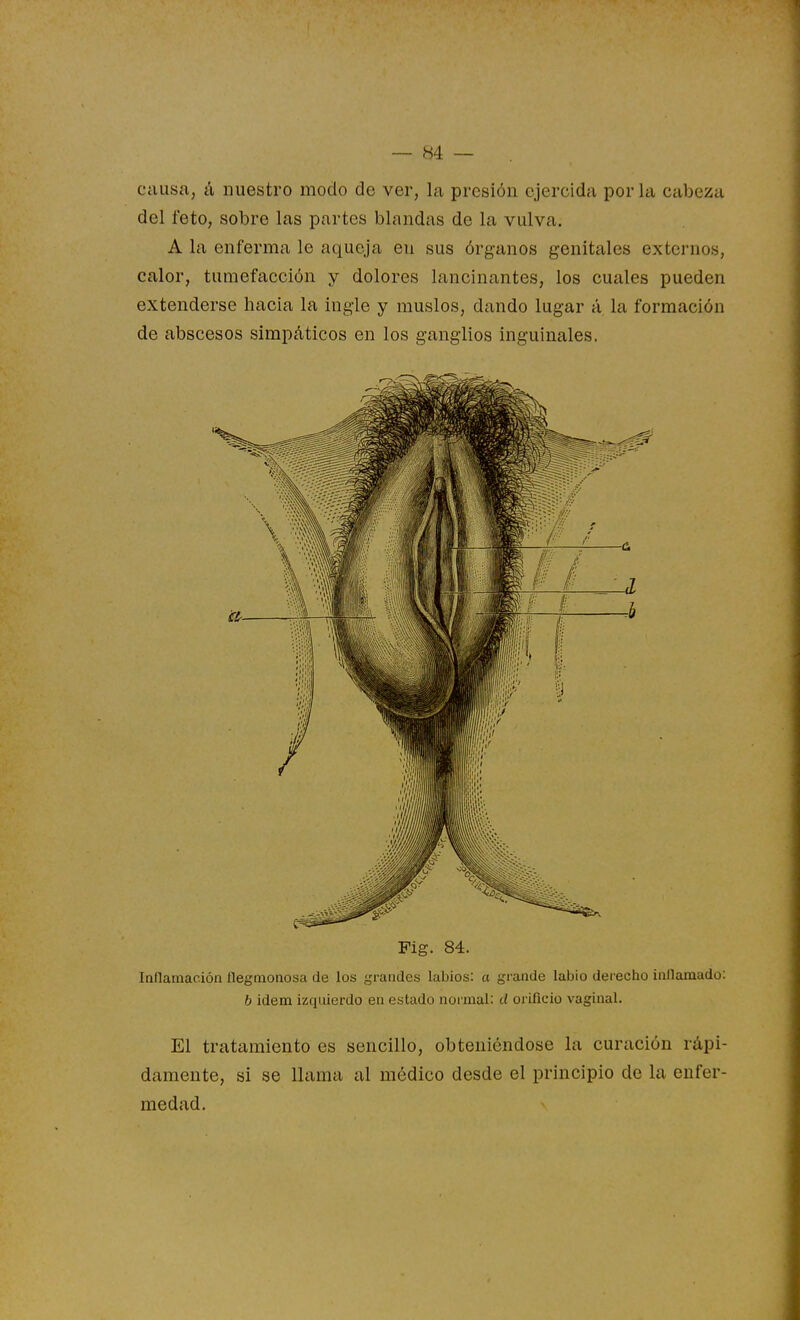 causa, á nuestro modo de ver, la presión ejercida por la cabeza del feto, sobre las partes blandas de la vulva. A la enferma le aqueja en sus órganos genitales externos, calor, tumefacción y dolores lancinantes, los cuales pueden extenderse hacia la ingle y muslos, dando lugar á la formación de abscesos simpáticos en los ganglios inguinales. Pig. 84. Inflamación llegmonosa de los grandes labios: a grande labio derecho inllamado; b Ídem izquierdo en estado noi-mal: d orificio vaginal. El tratamiento es sencillo, obteniéndose la curación rápi- damente, si se llama al médico desde el principio de la enfer- medad.