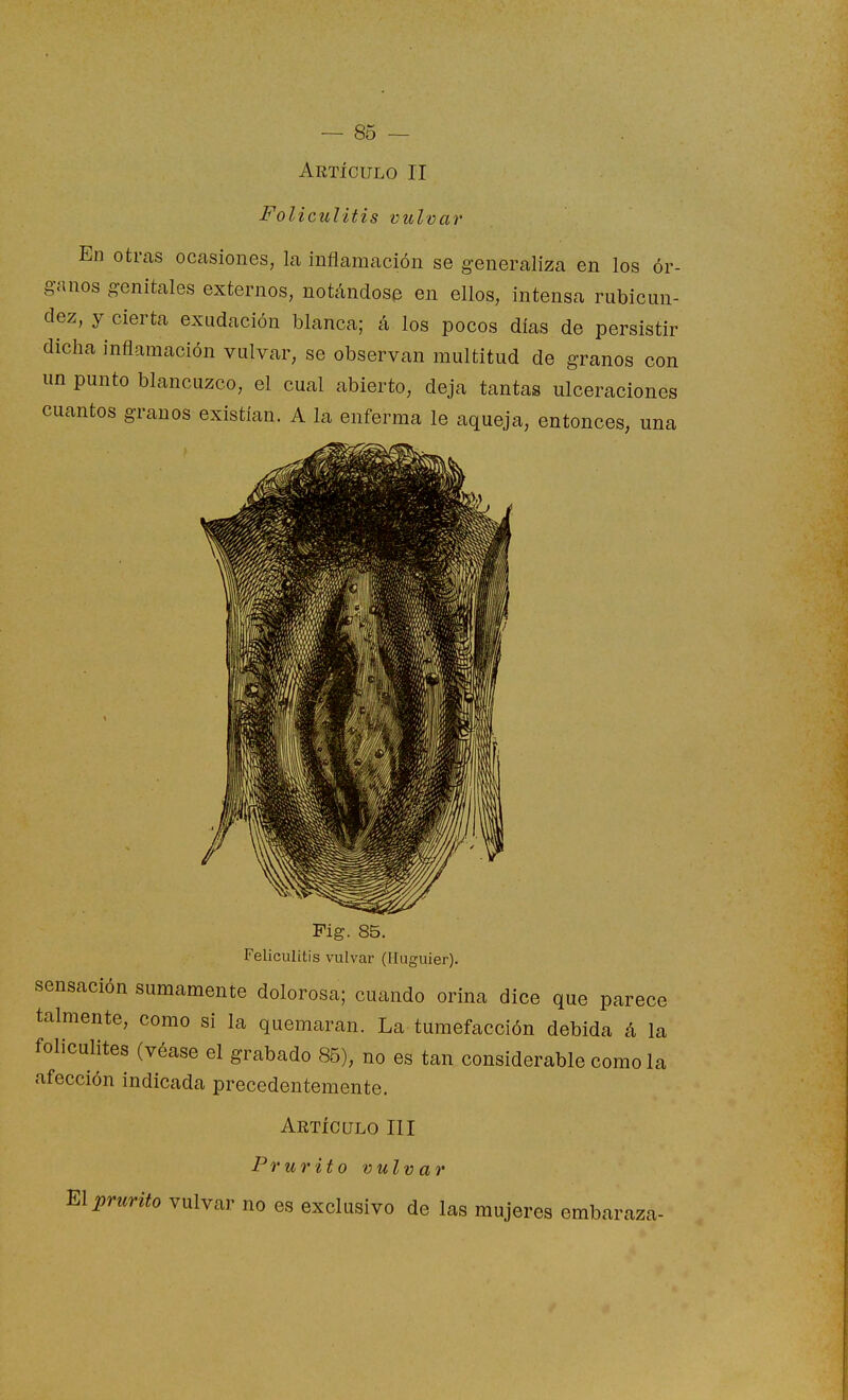 Articulo II Foliculitis vulvar En otras ocasiones, la inflamación se generaliza en los ór- ganos genitales externos, notándose en ellos, intensa rubicun- dez, y cierta exudación blanca; á los pocos días de persistir dicha inflamación vulvar, se observan multitud de granos con un punto blancuzco, el cual abierto, deja tantas ulceraciones cuantos granos existían. A la enferma le aqueja, entonces, una Pig. 85. Feliculitis vulvar (Iluguier). sensación sumamente dolorosa; cuando orina dice que parece talmente, como si la quemaran. La tumefacción debida á la foliculites (véase el grabado 85), no es tan considerable como la afección indicada precedentemente. Artículo III Prurito vulvar m prurito vulvar no es exclusivo de las mujeres embaraza-