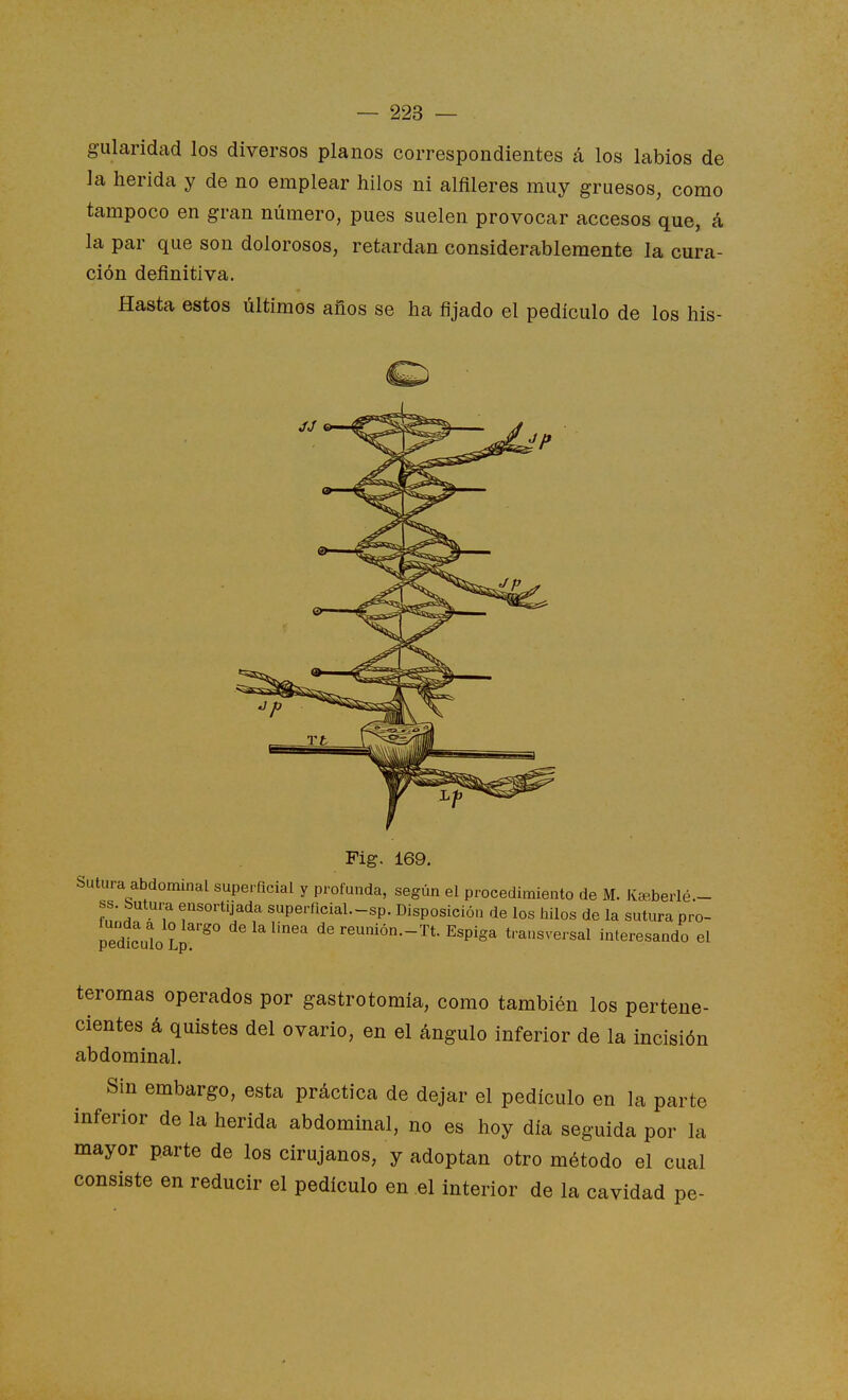 gularidad los diversos planos correspondientes á los labios de la herida y de no emplear hilos ni alfileres muy gruesos, como tampoco en gran número, pues suelen provocar accesos que, á la par que son dolorosos, retardan considerablemente la cura- ción definitiva. Hasta estos últimos años se ha fijado el pedículo de los his- Fig. 169. Sutura abdominal superficial y profunda, según el procedimiento de M. Kfe.berlé.- ss. Sutura ensortijada superficial.-sp. Disposición de los hilos de la sutura pro- pedtcVlo dereunión.-Tt. Espiga transversal interesando el teromas operados por gastrotomía, como también los pertene- cientes á quistes del ovario, en el ángulo inferior de la incisión abdominal. Sin embargo, esta práctica de dejar el pedículo en la parte inferior de la herida abdominal, no es hoy día seguida por la mayor parte de los cirujanos, y adoptan otro método el cual consiste en reducir el pedículo en el interior de la cavidad pe-