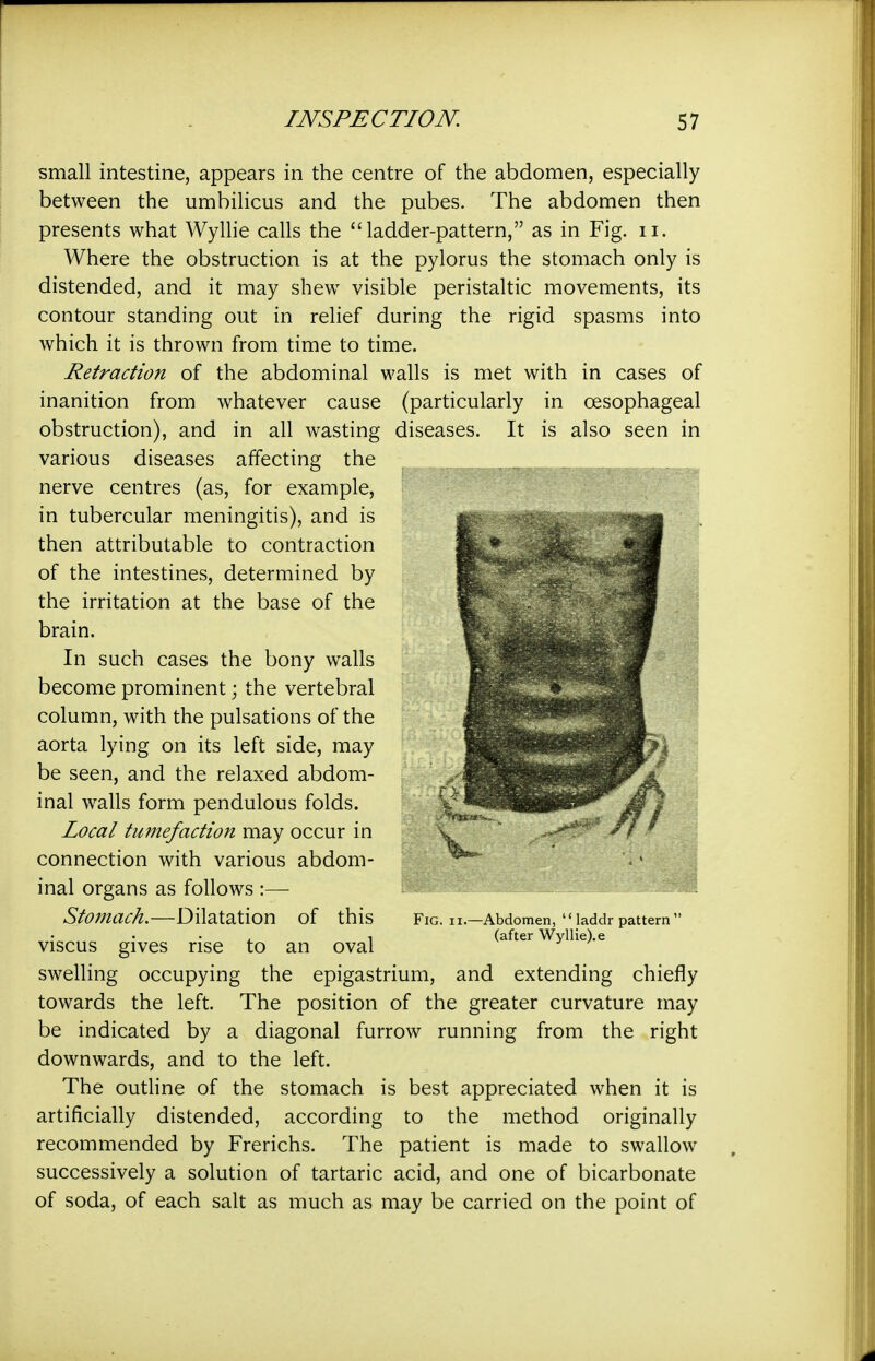 small intestine, appears in the centre of the abdomen, especially between the umbilicus and the pubes. The abdomen then presents what Wyllie calls the ladder-pattern, as in Fig. ii. Where the obstruction is at the pylorus the stomach only is distended, and it may shew visible peristaltic movements, its contour standing out in relief during the rigid spasms into which it is thrown from time to time. Retraction of the abdominal walls is met with in cases of inanition from whatever cause (particularly in oesophageal obstruction), and in all wasting diseases. It is also seen in various diseases affecting the nerve centres (as, for example, in tubercular meningitis), and is then attributable to contraction of the intestines, determined by the irritation at the base of the brain. In such cases the bony walls become prominent; the vertebral column, with the pulsations of the aorta lying on its left side, may be seen, and the relaxed abdom- inal walls form pendulous folds. Local tumefaction may occur in connection with various abdom- inal organs as follows :— Stomach.—Dilatation of this Fig. II.—Abdomen,  laddr pattern 1 (after Wyllie).e viscus gives rise to an oval swelling occupying the epigastrium, and extending chiefly towards the left. The position of the greater curvature may be indicated by a diagonal furrow running from the right downwards, and to the left. The outline of the stomach is best appreciated when it is artificially distended, according to the method originally recommended by Frerichs. The patient is made to swallow successively a solution of tartaric acid, and one of bicarbonate of soda, of each salt as much as may be carried on the point of