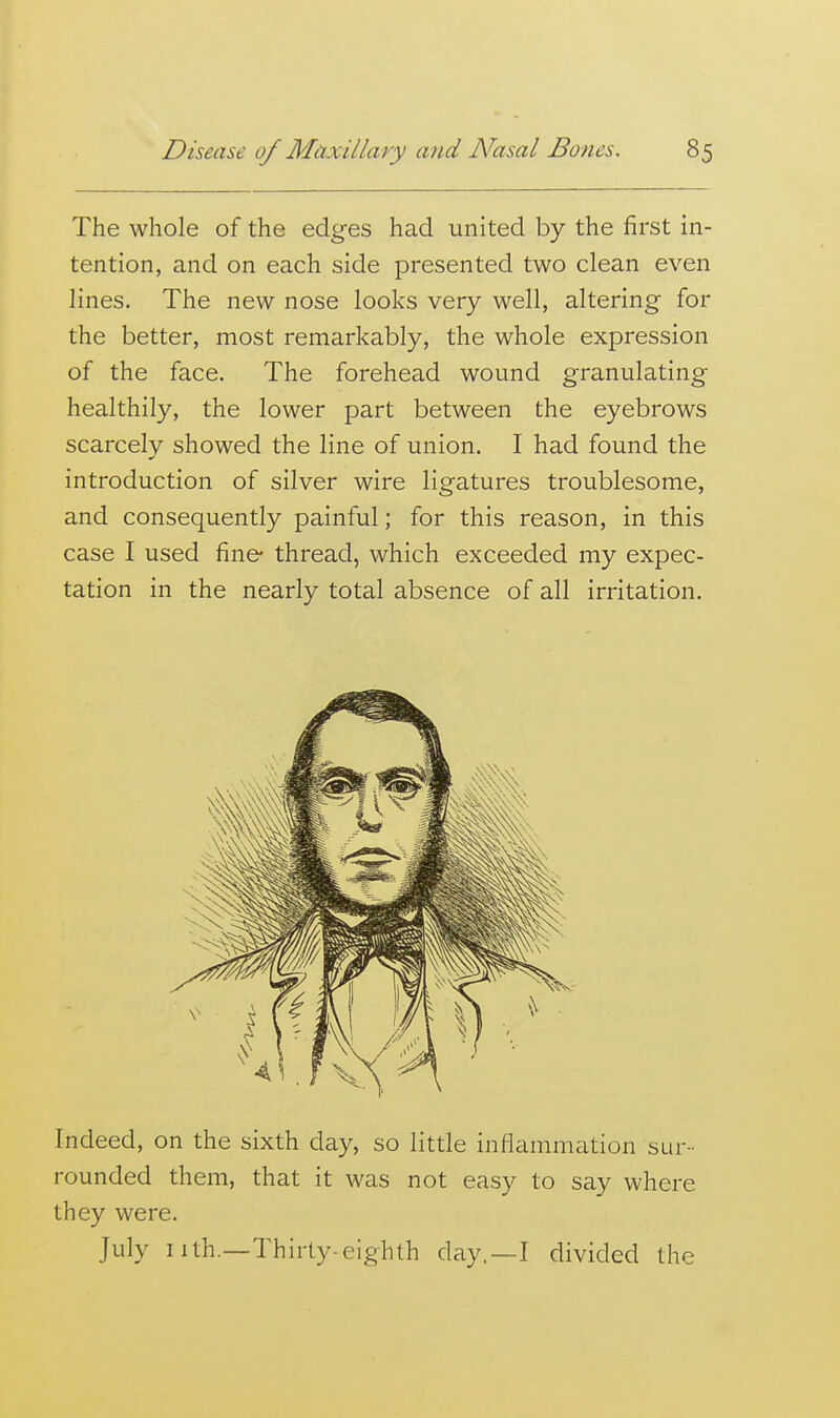 The whole of the edges had united by the first in- tention, and on each side presented two clean even lines. The new nose looks very well, altering for the better, most remarkably, the whole expression of the face. The forehead wound granulating healthily, the lower part between the eyebrows scarcely showed the line of union. I had found the introduction of silver wire ligatures troublesome, and consequently painful; for this reason, in this case I used fine thread, which exceeded my expec- tation in the nearly total absence of all irritation. Indeed, on the sixth day, so little inflammation sur- rounded them, that it was not easy to say where they were. July nth.—Thirty-eighth day.—I divided the