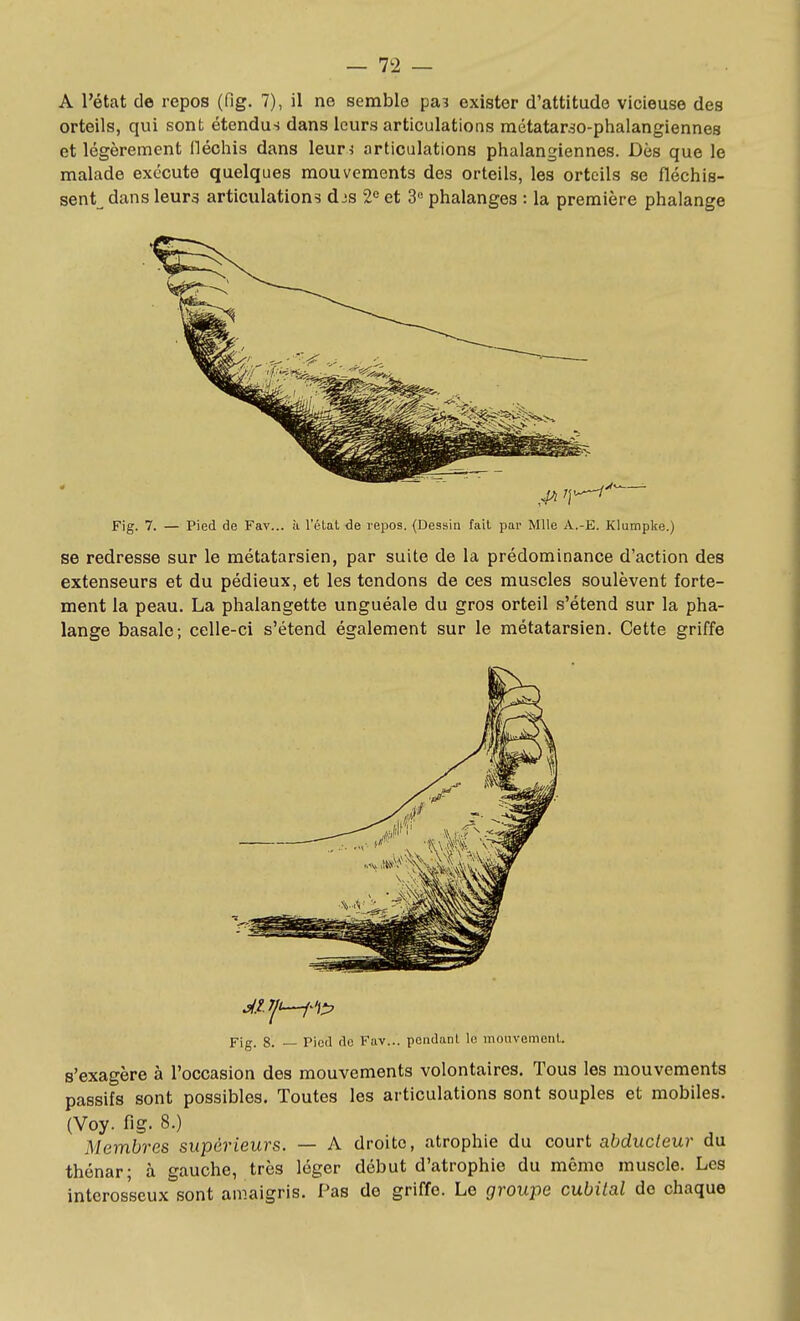 A l'état de repos (fig. 7), il ne semble pa? exister d'attitude vicieuse des orteils, qui sont étendus dans leurs articulations raétatar^o-phalangiennes et légèrement Hécliis dans leur ^ articulations phalangiennes. Dès que le malade exécute quelques mouvements des orteils, les orteils se fléchis- sent^ dans leurs articulations dis 2^ et 3« phalanges : la première phalange Fig. 7. — Pied de Fav,.. à l'élat de repos. (Dessin fait par Mlle A.-E. Klumpke.) se redresse sur le métatarsien, par suite de la prédominance d'action des extenseurs et du pédieux, et les tendons de ces muscles soulèvent forte- ment la peau. La phalangette unguéale du gros orteil s'étend sur la pha- lange basale; celle-ci s'étend également sur le métatarsien. Cette griffe Fig. 8. — Pied de Fav... pendanl le inouvemonl. s'exagère à l'occasion des mouvements volontaires. Tous les mouvements passifs sont possibles. Toutes les articulations sont souples et mobiles. (Voy. fig. 8.) Membres supérieurs. — A droite, atrophie du court afeduc/eur du thénar; à gauche, très léger début d'atrophie du même muscle. Les interosseux sont amaigris. Pas do griffe. Le groujie cubital de chaque