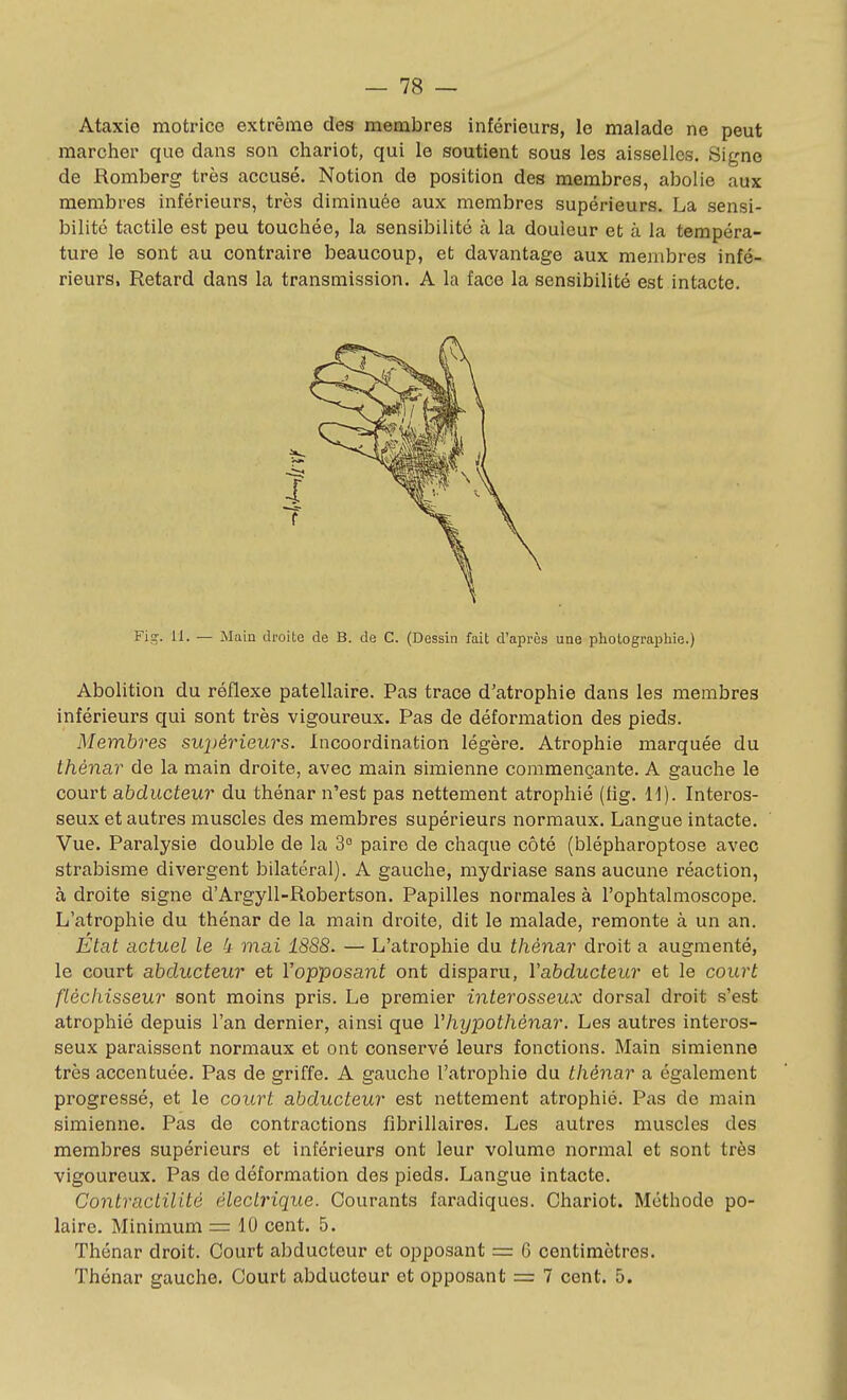 Ataxie motrice extrême des membres inférieurs, le malade ne peut marcher que dans son chariot, qui le soutient sous les aisselles. Signe de Romberg très accusé. Notion de position des membres, abolie aux membres inférieurs, très diminuée aux membres supérieurs. La sensi- bilité tactile est peu touchée, la sensibilité à la douleur et à la tempéra- ture le sont au contraire beaucoup, et davantage aux membres infé- rieurs. Retard dans la transmission. A la face la sensibilité est intacte. Fig. 11. — Main droite de B. de C. (Dessin fait d'après une photographie.) Abolition du réflexe patellaire. Pas trace d'atrophie dans les membres inférieurs qui sont très vigoureux. Pas de déformation des pieds. Membres supérieurs. Incoordination légère. Atrophie marquée du thénar de la main droite, avec main simienne commençante. A gauche le court abducteur du thénar n'est pas nettement atrophié (fig. 11). Interos- seux et autres muscles des membres supérieurs normaux. Langue intacte. Vue. Paralysie double de la 3° paire de chaque côté (blépharoptose avec strabisme divergent bilatéral). A gauche, mydriase sans aucune réaction, à droite signe d'Argyll-Robertson. Papilles normales à l'ophtalmoscope. L'atrophie du thénar de la main droite, dit le malade, remonte à un an. Etat actuel le 4 mai 1888. — L'atrophie du thénar droit a augmenté, le court abducteur et Vopposant ont disparu, Vabducteur et le court fléchisseur sont moins pris. Le premier interosseux dorsal droit s'est atrophié depuis l'an dernier, ainsi que Vhypothénar. Les autres interos- seux paraissent normaux et ont conservé leurs fonctions. Main simienne très accentuée. Pas de griffe. A gauche l'atrophie du thénar a également progressé, et le court abducteur est nettement atrophié. Pas de main simienne. Pas de contractions fibrillaires. Les autres muscles des membres supérieurs et inférieurs ont leur volume normal et sont très vigoureux. Pas de déformation des pieds. Langue intacte. Co7itractilitô électrique. Courants faradiques. Chariot. Méthode po- laire. Minimum — 10 cent. 5. Thénar droit. Court abducteur et opposant = 6 centimètres. Thénar gauche. Court abducteur et opposant = 7 cent. 5.