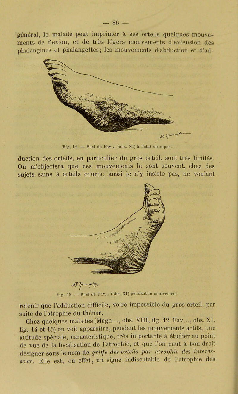 — 8() — général, le malade peut imprimer à ses orteils quelques mouve- ments de flexion, et de très légers mouvements d'extension des phalangines et phalangettes; les mouvements d'abduction et d'ad- Fig. 14. — Pied de Fav... (obs. XI) à l'état de repos. duction des orteils, en particulier du gros orteil, sont très limités. On m'objectera que ces mouvements le sont souvent, chez des sujets sains à orteils courts; aussi je n'y insiste pas, ne voulant Fijr. ■15_ Pied de Fav... (obs. XI) pendant le mouvement. retenir que l'adduction difficile, voire impossible du gros orteil, par suite de l'atrophie du thénar. Chez quelques malades (Magn..., obs. XIII, fig. 12, Fav..., obs. XI, fig. 14 et 15) on voit apparaître, pendant les mouvements actifs, une attitude spéciale, caractéristique, très importante à étudier au point de vue de la localisation de l'atrophie, et que l'on peut à bon droit désigner sous le nom de gri^^ des orteils par atrophie des interos- seux. Elle est, en effet, un signe indiscutable de l'atrophie des