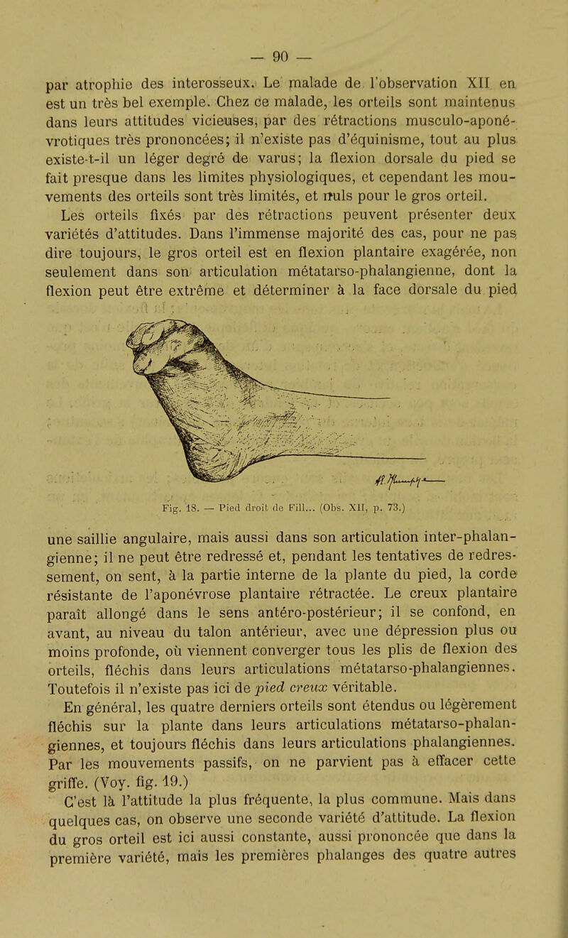 par atrophie des interosseux. Le jnalade de l'observation XII en, est un très bel exemple. Chez Ce malade, les orteils sont maintenus dans leurs attitudes viciewSeSi par des rétractions musculo-aponé- vrotiques très prononcées; il n'existe pas d'équinisme, tout au plus existe-t-il un léger degré de varus; la flexion dorsale du pied se fait presque dans les limites physiologiques, et cependant les mou- vements des orteils sont très limités, et lîuls pour le gros orteil. Les orteils fixés par des rétractions peuvent présenter deux variétés d'attitudes. Dans l'immense majorité des cas, pour ne pas, dire toujours, le gros orteil est en flexion plantaire exagérée, non seulement dans son- articulation métatarso-phalangienne, dont la flexion peut être extrême et déterminer à la face dorsale du pied Fig. IS. — Pied droit do Fill... (Obs. XII, p. 73.) une saillie angulaire, mais aussi dans son articulation inter-phalan- gienne; il ne peut être redressé et, pendant les tentatives de redres- sement, on sent, à la partie interne de la plante du pied, la corde résistante de l'aponévrose plantaire rétractée. Le creux plantaire paraît allongé dans le sens antéro-postérieur; il se confond, en avant, au niveau du talon antérieur, avec une dépression plus ou moins profonde, où viennent converger tous les plis de flexion des orteils, fléchis dans leurs articulations métatarse-phalangiennes. Toutefois il n'existe pas ici de pied creux véritable. En général, les quatre derniers orteils sont étendus ou légèrement fléchis sur la plante dans leurs articulations métatarso-phalan- giennes, et toujours fléchis dans leurs articulations phalangiennes. Par les mouvements passifs, on ne parvient pas à effacer cette griffe. (Voy. fig. 19.) C'est là l'attitude la plus fréquente, la plus commune. Mais dans quelques cas, on observe une seconde variété d'attitude. La flexion du gros orteil est ici aussi constante, aussi prononcée que dans la première variété, mais les premières phalanges des quatre autres