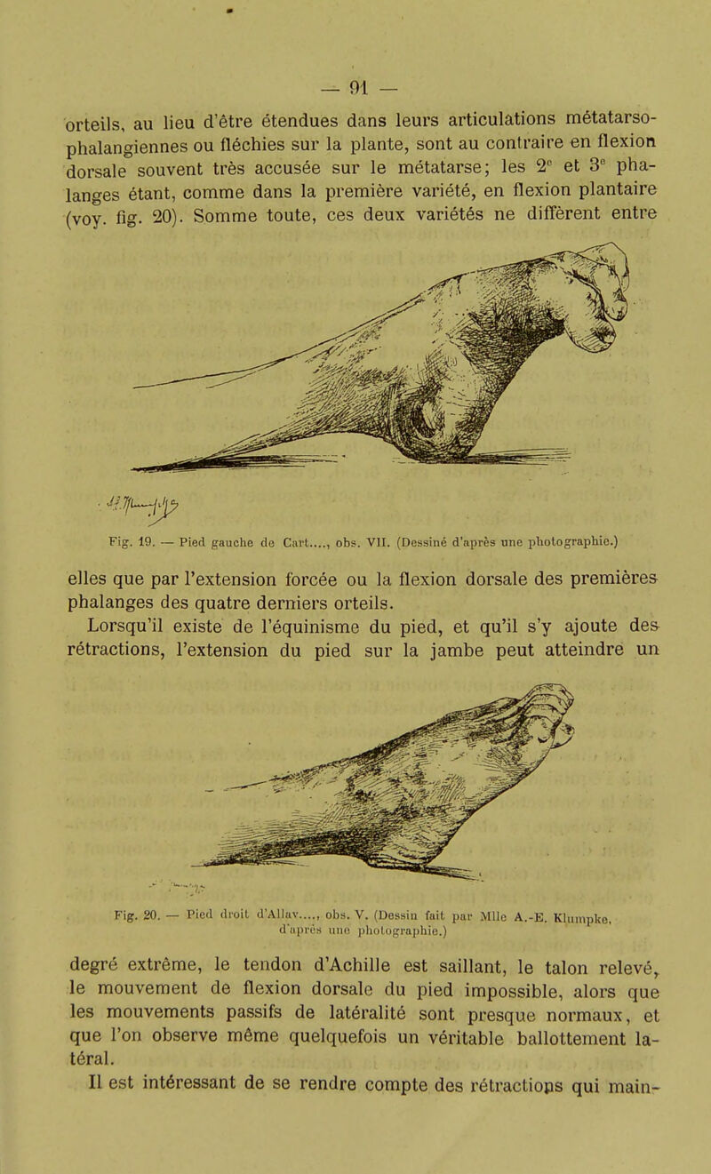 orteils, au lieu d'être étendues dans leurs articulations métatarso- phalangiennes ou fléchies sur la plante, sont au contraire en flexion dorsale souvent très accusée sur le métatarse; les 2'' et 3 pha- langes étant, comme dans la première variété, en flexion plantaire (voy. fig. 20). Somme toute, ces deux variétés ne difl'èrent entre Fig. 19. — Pied gauche de Cart...., obs. VlI. (Dessiné d'après une photographie.) elles que par l'extension forcée ou la flexion dorsale des premières phalanges des quatre derniers orteils. Lorsqu'il existe de l'équinisme du pied, et qu'il s'y ajoute des- rétractions, l'extension du pied sur la jambe peut atteindre un Fig. 20. — Pied droil d'Allav...., ohs. V. (Dessin fait par Mlle A.-E. Kliimpke. d'après une photographie.) degré extrême, le tendon d'Achille est saillant, le talon relevé^ le mouvement de flexion dorsale du pied impossible, alors que les mouvements passifs de latéralité sont presque normaux, et que l'on observe même quelquefois un véritable ballottement la- téral. Il est intéressant de se rendre compte des rétractiops qui main-