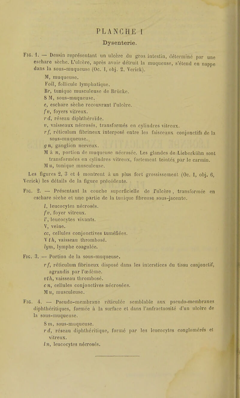 Dysenterie. FiG. 1. — Dessin représentant un ulcère du gros intestin, iléterminé par une eschare sèche. L'ulcère, après avoir détruit la muqueuse, s'étend en nappe dans la sous-muqucuso (Oc. I, obj. 2, Vcrick). M, muqueuse. ToU, follicule lymphatique. Br, tunique musculeusc de Briicke. S M, sous-muqucusc. e, eschare sèche recouvrant l'ulcère. fv, foyers vitreux. rcl, réseau diphthéroïde. V, vaisseaux nécrosés, transformés en cylindres vitreux. rf, réliculum fibrineiix interposé entre les faisceaux conjonctifs de la sous-muqueuse., gn, ganglion nerveux. M à n, portion de muquousc nécrosée. Les glandes de Lieberkiihn sont transformées en cylindres vitreux, fortement teintés par le carmin. Mu, tunique musculeusc. Les figures 2, 3 et i montrent à un plus fort grossissement (Oc. I, obj. 6, Vcrick) les détails de la figure précédente. FiG. 2. — Présentant la couche superficielle de l'ulcère , transformée en eschare sèche et une partie de la tunique fibreuse sous-jacente. l, leucocytes nécrosés. fv, foyer vitreux. l', leucocytes vivants. V, veine. ce, cellules conjonctives tuméfiées. \ th, vaisseau thrombosé. lym, lymphe coagulée. FiG. .S. — Portion de la sous-muqueuse. r f, réticulum fibrineux disposé dans les interstices du tissu conjonctif, agrandis par l'œdème. vth, vaisseau thrombosé. en, cellules conjonctives nécrosées. M u, musculeuse. Fie. i. — Pseudo-membrane réticulée semblable aux pseudo-membranes diphthérltiques, formée à la surface et dans l'anfractuosité d'un ulcère de la sous-muqueuse. S m, sous-muqueuse. rrf, réseau diphtliériliquc, formé par les leucocytes conglomérés et vitreux. In, leucocytes nécrosés.