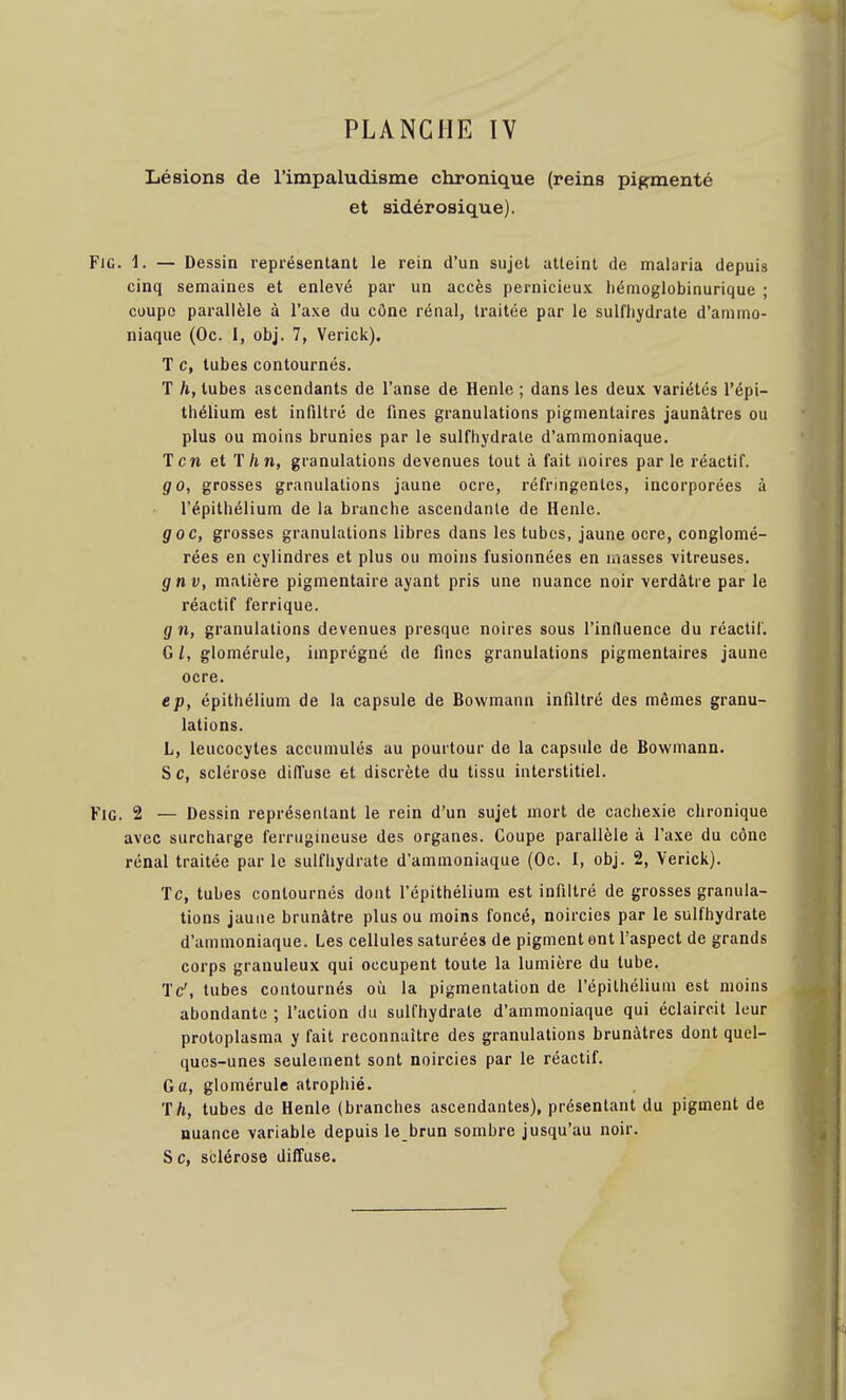 Lésions de l'impaludisme chronique (reins pigmenté et sidérosique). FiG. 1. — Dessin représentant le rein d'un sujet atteint de malaria depuis cinq semaines et enlevé par un accès pernicieux liémoglobinurique ; coupe parallèle à l'axe du cône rénal, traitée par le sulfhydrate d'ammo- niaque (Oc. 1, obj. 7, Verick). T c, tubes contournés. T h, tubes ascendants de l'anse de Henle ; dans les deux variétés l'épi- tliélium est infiltré de fines granulations pigmentaires jaunâtres ou plus ou moins brunies par le sulfhydrate d'ammoniaque. Tcn et T/in, granulations devenues tout à fait noires par le réactif. go, grosses granulations jaune ocre, réfringentes, incorporées à l'épithélium de la branche ascendante de Henle. g oc, grosses granulations libres dans les tubes, jaune ocre, conglomé- rées en cylindres et plus ou moins fusionnées en masses vitreuses. gnv, matière pigmentaire ayant pris une nuance noir verdâtre par le réactif ferrique. g n, granulations devenues presque noires sous l'influence du réactif. G /, glomérule, imprégné de fines granulations pigmentaires jaune ocre. ep, épithélium de la capsule de Bowmann infiltré des mômes granu- lations. L, leucocytes accumulés au pourtour de la capsule de Bowmann. S c, sclérose diffuse et discrète du tissu interstitiel. FiG. 2 — Dessin représentant le rein d'un sujet mort de cachexie chronique avec surcharge ferrugineuse des organes. Coupe parallèle à l'axe du cône rénal traitée par le sulfiiydrate d'ammoniaque (Oc. I, obj. 2, Verick). Te, tubes contournés dont l'épithélium est infiltré de grosses granula- tions jaune brunâtre plus ou moins foncé, noircies par le sulfhydrate d'ammoniaque. Les cellules saturées de pigment ont l'aspect de grands corps granuleux qui occupent toute la lumière du tube. IV, tubes contournés où la pigmentation de l'épithélium est moins abondante ; l'action du sulfhydrate d'ammoniaque qui éclaircit leur protoplasma y fait reconnaître des granulations brunâtres dont quel- ques-unes seulement sont noircies par le réactif. G a, glomérule atrophié. T/i, tubes de Henle (branches ascendantes), présentant du pigment de nuance variable depuis le brun sombre jusqu'au noir. Se, sclérose diffuse.