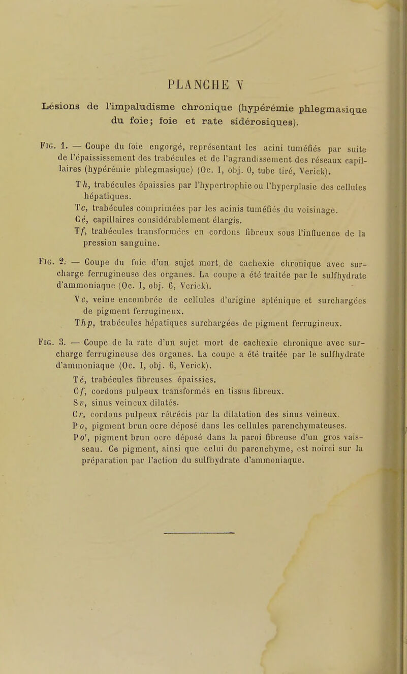 Lésions de l'impaludisme chronique (hypérémie phlegmasique du foie; foie et rate sidérosiques). FiG. 1. — Coupe du l'oie engorgé, représentant les acini tuméfiés par suite de l'épaississement des trabécules et de l'agrandissenient des réseaux capil- laires (hypérémie phlegmasique) (Oc. I, obj. 0, tube tiré, Verick). Th, trabécules épaissies par l'hypertrophie ou l'hyperplasie des cellules hépatiques. Te, trabécules comprimées par les acinis tuméfiés du voisinage. Ce, capillaires considérablement élargis. Tf, trabécules transformées en cordons fibreux sous l'influence de la pression sanguine. FiG. 2. — Coupe du foie d'un sujet mort, de cachexie chronique avec sur- charge ferrugineuse des organes. La coupe a été traitée par le sulfhydrale d'ammoniaque (Oc. I, obj. 6, Vcrick)- Vc, veine encombrée de cellules d'origine splénique et surchargées de pigment ferrugineux. Thp, trabécules hépatiques surchargées de pigment ferrugineux. FiG. 3. — Coupe de la rate d'un sujet mort de cachexie chronique avec sur- charge ferrugineuse des organes. La coupe a été traitée par le sulfhydrale d'ammoniaque (Oc. I, obj. 6, Verick). Te, trabécules fibreuses épaissies. Cf, cordons pulpeux transformés en tissus fibreux. Sv, sinus veineux dilatés. Cr, cordons pulpeux rétrécis par la dilatation des sinus veineux. P 0, pigment brun ocre déposé dans les cellules parenchymateuses. Po', pigment brun ocre déposé dans la paroi fibreuse d'un gros vais- seau. Ce pigment, ainsi que celui du parenchyme, est noirci sur la préparation pur l'action du sulfliydrate d'ammoniaque.