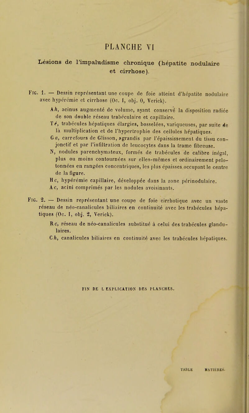 Lésions de l'impaludisme chronique (hépatite nodulaire et cirrhose). Fie. 1. — Dessin représentant une coupe de foie atteint d'hcpalile nodulaire avec hypérémic et cirrhose (Oc. I, obj. 0, Vcrick). Ah, acinus augmenté de volume, ayant conservé la disposition radiée de son double réseau trabéculaire et capillaire. 'té, trabécules hépatiques élargies, bosselées, variqueuses, par suite de la multiplication et de l'hypertrophie des cellules hépatiques. G a, carrefours de Glisson, agrandis par l'épaississement du tissu con- jonctif et par l'infiltration de leucocytes dans la trame fibreuse. N, nodules parenchymateux, formés de trabécules de calibre inégal, plus ou moins contournées sur elles-mêmes et ordinairement pelo- tonnées en rangées concentriques, les plus épaisses occupant le centre de la figure. Hc, hypérémie capillaire, développée dans la zone périnodulaire, Ac, acini comprimés par les nodules avoisinants. FiG. 2. — Dessin représentant une coupe de foie cirrhotique avec un vaste réseau de néo-canalicules biliaires en continuité avec les trabécules hépa- tiques (Oc. I, obj. 2, Verick). Rc, réseau de néo-canalicules substitué à celui des trabécules glandu- laires. Cft, canalicules biliaires en continuité avec les trabécules hépatiques. FIN DE L tXPLICATlON DES PLANCHES. TAIILB HATIEREâ.