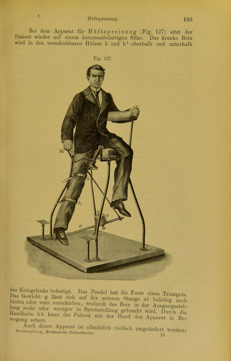 I Hüftspreizung. 193 Bei dem Apparat für Hüftspreizung (Fig. 127) sitzt der Patient wieder auf einem damensattelartigen Sitze. Das kranke Bein wird in den verschiebbaren Hülsen h und oberhalb und unterhalb Fig. 127. des Kniegelenks befestigt. Das Pendel hat die Form eines Triangels Das Gewicht g lässt sich auf der unteren Stange st b^Hebirnach hinten oder vorn verschieben, wodurch das Bein in der Aus^s td- lung mehr oder weniger in Spreiz.stcllung gebracht wird DuS dt ttzen.'^ ''^ Apparaten'B^ K.^l^Z.ilS:';^!:;,:;!::'^^''''«^ -^^^^ umgeändert worden;