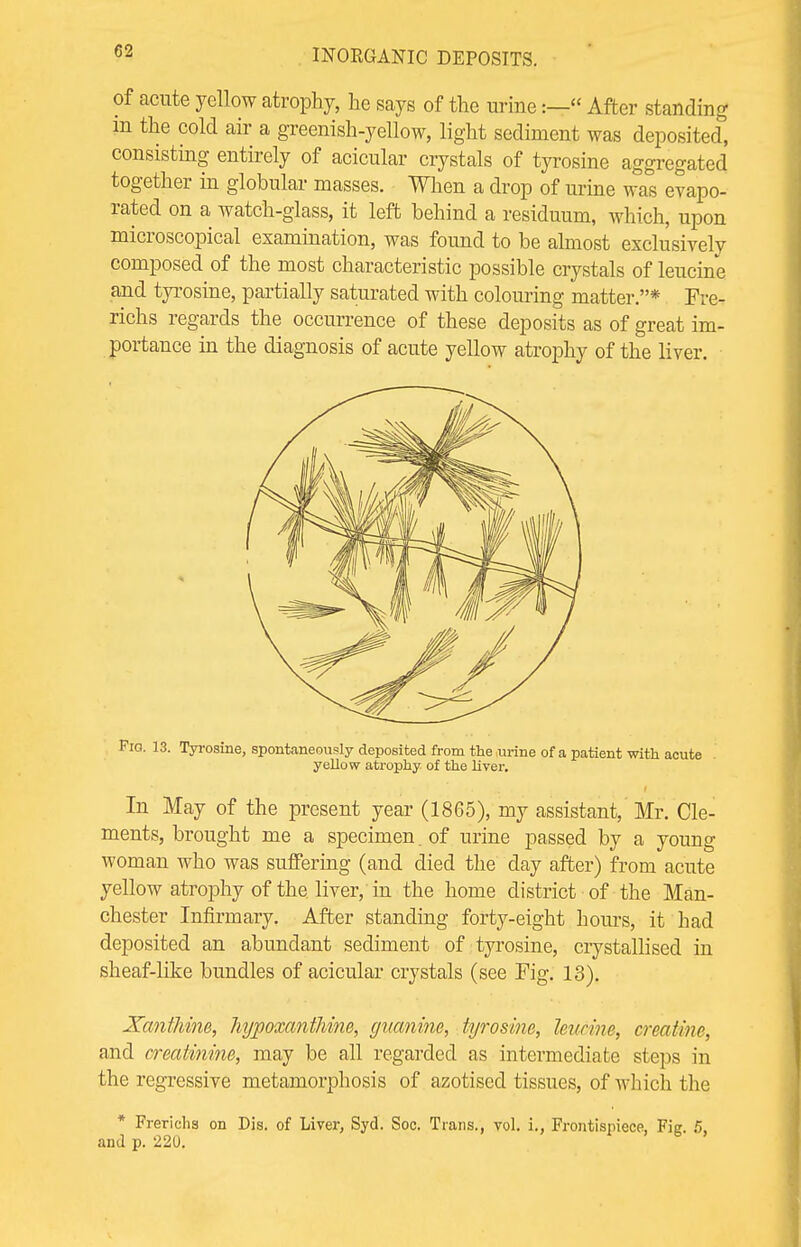 of acute yellow atrophy, he says of the urine:— After standing m the cold air a greenish-yellow, light sediment was deposited, consisting entirely of acicular crystals of tyrosine aggregated together in globular masses. When a drop of urine was evapo- rated on a watch-glass, it left behind a residuum, which, upon microscopical examination, was found to be almost exclusively composed of the most characteristic possible crystals of leucine and tyrosine, partially saturated with colouring matter.* Fre- richs regards the occurrence of these deposits as of great im- portance in the diagnosis of acute yellow atrophy of the liver. Pig. 13. Tyrosine, spontaneously deposited from theiu-ine of a patient with acute yellow atrophy of the liver. In May of the present year (1865), my assistant, Mr. Cle- ments, brought me a specimen. of urine passed by a young woman who was suffering (and died the day after) from acute yellow atrophy of the liver, in the home district of the Man- chester Infirmary. After standing forty-eight hours, it had deposited an abundant sediment of tyrosine, crystallised in sheaf-like bundles of acicular crystals (see Fig. 13). Xanthine, JiypoxantMne, guanine, tyrosine, leucine, creatine, and creatinine, may be all regarded as intermediate steps in the regressive metamorphosis of azotised tissues, of which the * Frerichs on Dis. of Liver, Syd. Soc. Trans., vol. i., Frontispiece, Fig. 5, and p. 220.