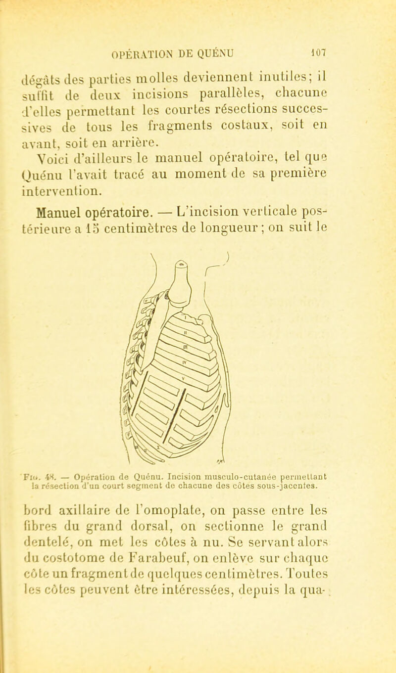 dégâts des parties molles deviennent inutiles; il sutîit de deux incisions parallèles, chacune d'elles permettant les courtes résections succes- sives de tous les fragments costaux, soit en avant, soit en arrière. Voici d'ailleurs le manuel opératoire, tel que (Juénu l'avait tracé au moment de sa première intervention. Manuel opératoire. — L'incision verticale pos- térieure a la centimètres de longueur ; on suit le Fiii. 4-S. — Opération de Quénu. Incision rausculo-outanée permellant la résection d'un court segment de chacune des côtes sous-jacentes. bord axillaire de l'omoplate, on passe entre les fibres du grand dorsal, on sectionne le grand dentelé, on met les côtes à nu. Se servant alors du costotome de Farabeuf, on enlève sur chaque côte un fragment de quelques centimètres. Toutes les côtes peuvent être intéressées, depuis la qua-.