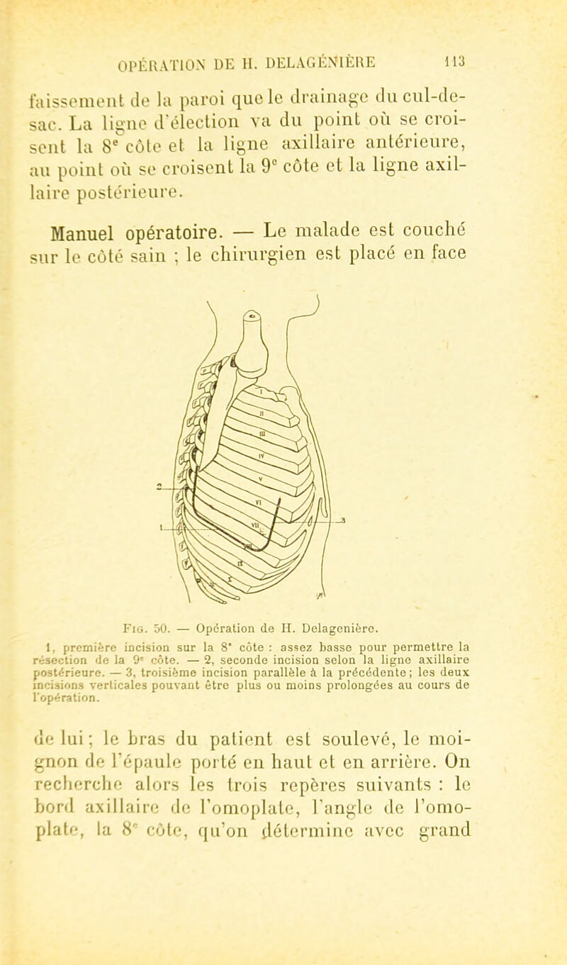 faissoment de la paroi que le drainage du cul-de- sac. La ligne d'élection va du point où se croi- sent la 8'côte et la ligne axiliaire antérieure, au point où se croisent la 9° côte et la ligne axil- iaire postérieure. Manuel opératoire. — Le malade est couché sur le côté sain ; le chirurgien est placé en face FiG. 50. — Opération de H. Delagenièro. I, première incision sur la 8* côte : assez basse pour permettre la résection do la 9' côte. — 2, seconde incision selon la ligne axiliaire postérieure. — 3, troisième incision parallèle à la précédente; les deux incisions verticales pouvant être plus ou moins prolongées au cours de ropé ration. de lui ; le bras du patient est soulevé, le moi- gnon de Tépaule porté en haut et en arrière. On recherche alors les trois repères suivants : le bord axiliaire de l'omoplate, l'angle de l'omo- plate, la 8*^ côte, qu'on détermine avec grand