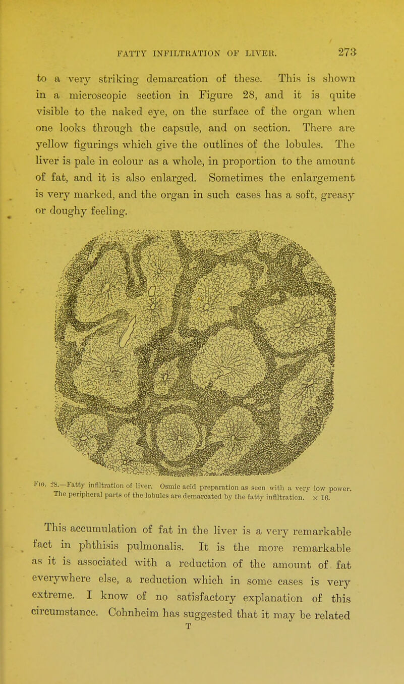 to a very striking demarcation of these. This is shown in a microscopic section in Figure 28, and it is quite visible to the naked eye, on the surface of the organ when one looks through the capsule, and on section. There are yellow figurings which give the outlines of the lobules. The liver is pale in colour as a whole, in proportion to the amount of fat, and it is also enlarged. Sometimes the enlargement is very marked, and the organ in such cases has a soft, greasy or doughy feeling. !.—Fatty infiltration of liver. Osmic acid preparation as seen with a very low j Hie peripheral parts of the lobules are demarcated by the fatty infiltration, x 16. This accumulation of fat in the liver is a very remarkable fact in phthisis pulmonalis. It is the more remarkable as it is associated with a reduction of the amount of fat everywhere else, a reduction which in some cases is very extreme. I know of no satisfactory explanation of this circumstance. Cohnheim has suggested that it may be related T