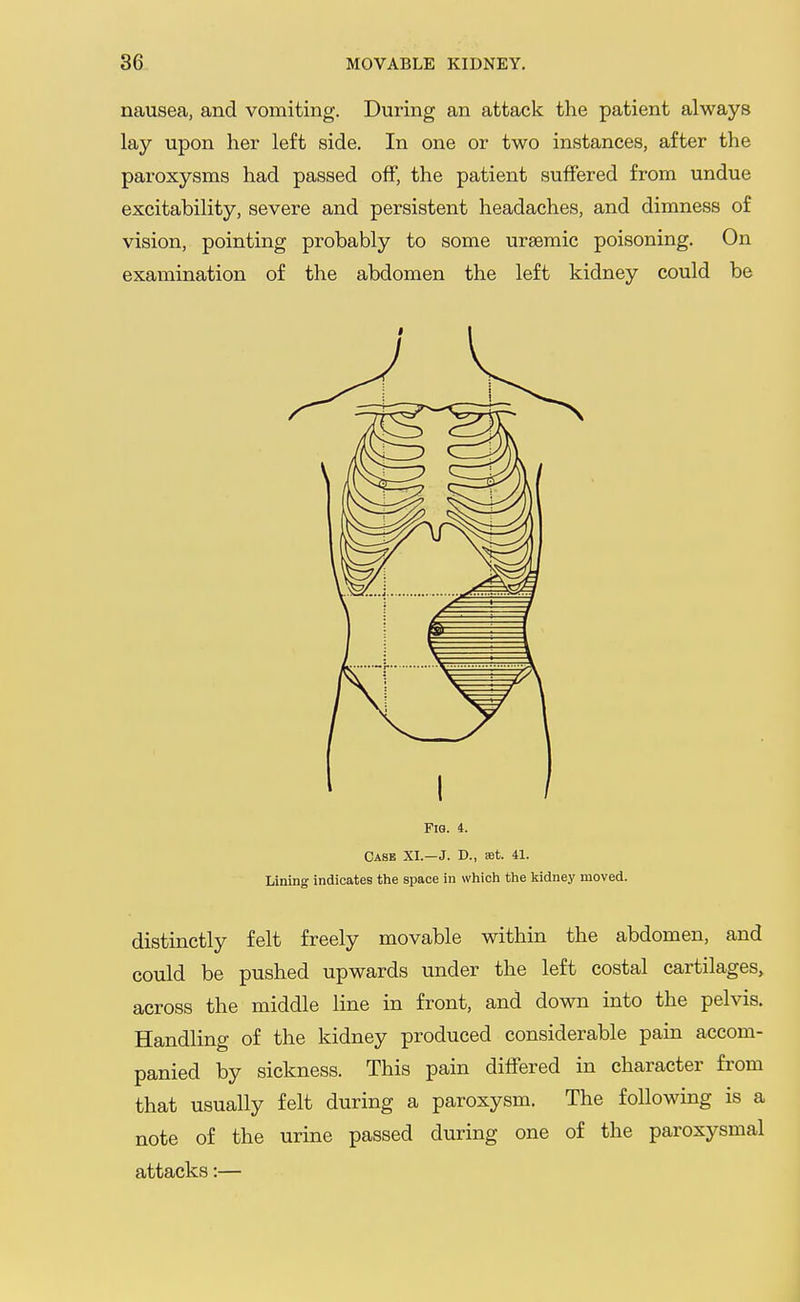 nausea, and vomiting. During an attack the patient always lay upon her left side. In one or two instances, after the paroxysms had passed off, the patient suffered from undue excitability, severe and persistent headaches, and dimness of vision, pointing probably to some ursemic poisoning. On examination of the abdomen the left kidney could be FiQ. 4. Case XI.—J. D., set. 41. Lining indicates the space in which the kidney moved. distinctly felt freely movable within the abdomen, and could be pushed upwards under the left costal cartilages, across the middle line in front, and down into the pelvis. Handling of the kidney produced considerable pain accom- panied by sickness. This pain differed in character from that usually felt during a paroxysm. The following is a note of the urine passed during one of the paroxysmal attacks:—