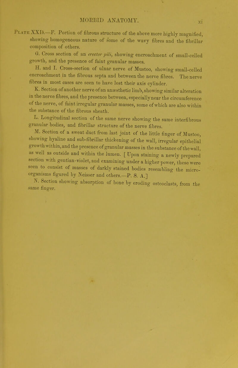 MORBID ANATOMY. Plate XXlb.—F. Portion of fibrous structure of the above more highly magnified, showing homogeneous nature of some of the wavy fibres and the fibrillar composition of others. G. Cross section of an erector pili, showing encroachment of small-celled growth, and the presence of faint granular masses. H. and I. Cross-section of ulnar nerve of Mustoo, showing small-celled encroachment in the fibrous septa and between the nerve fibres. The nerve fibres in most cases are seen to have lost their axis cylinder. K. Section of another nerve of an anaesthetic limb, showing similar alteration in the nerve fibres, and the presence between, especially near the circumference of the nerve, of faint irregular granular masses, some of which are also within the substance of the fibrous sheath. L. Longitudinal section of the same nerve showing the same interfibrous granular bodies, and fibrillar structure of the nerve fibres. M. Section of a sweat duct from last joint of the little finger of Mustoo, showing hyaline and sub-fibrillar thickening of the wall, irregular epithelial growth within, and the presence of granular masses in the substance of the wall, as well as outside and within the lumen. [ Upon staining a newly prepared section with gentian-violet, and examining under a higher power, these were seen to consist of masses of darkly stained bodies resembling the micro- organisms figured by Neisser and others.—P. S. A.] N. Section showing absorption of bone by eroding osteoclasts, from the same fing-er.