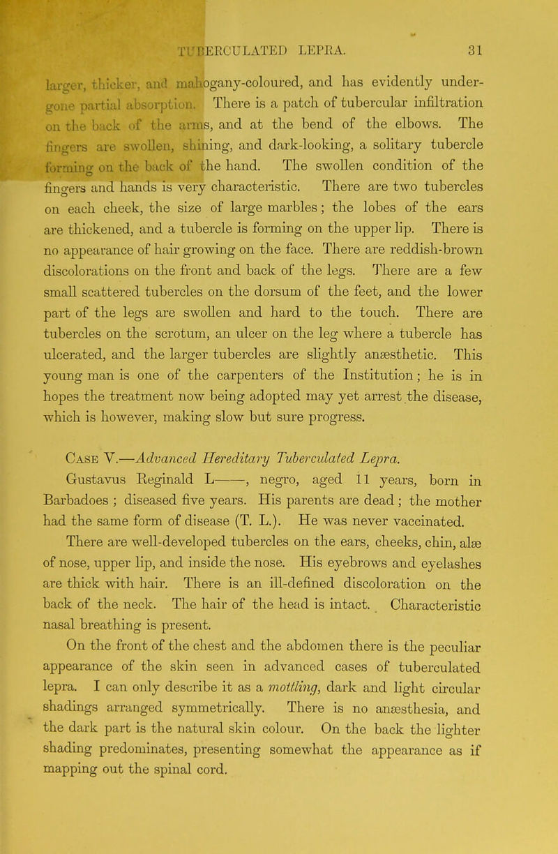 larger, thicker, and mahogany-coloured, and has evidently under- gone partial absorption. There is a patch of tubercular infiltration on the back of the arms, and at the bend of the elbows. The fingers are swollen, shining, and dark-looking, a solitary tubercle formincr on the back of the hand. The swollen condition of the fino-ers and hands is very characteiistic. There are two tubercles on each cheek, the size of large marbles; the lobes of the ears are thickened, and a tubercle is forming on the upper lip. There is no appearance of hair growing on the face. There are reddish-brown discolorations on the front and back of the legs. There are a few small scattered tubercles on the dorsum of the feet, and the lower part of the legs are swollen and hard to the touch. There are tubercles on the scrotum, an ulcer on the leg where a tubercle has ulcerated, and the larger tubercles are slightly anaesthetic. This young man is one of the carpenters of the Institution; he is in hopes the treatment now being adopted may yet arrest the disease, which is however, making slow but sure progress. Case Y.—Advanced Hereditary Tuherculated Lepra. Gustavus Reginald L , negro, aged 11 years, born in Barbadoes ; diseased five years. His parents are dead; the mother had the same form of disease (T. L.). He was never vaccinated. There are weU-developed tubercles on the ears, cheeks, chin, alse of nose, upper lip, and inside the nose. His eyebrows and eyelashes are thick with hair. There is an ill-defined discoloration on the back of the neck. The hair of the head is intact. Characteristic nasal breathing is present. On the front of the chest and the abdomen there is the peculiar appearance of the skin seen in advanced cases of tuherculated lepra. I can only describe it as a mottling, dark and light circular shadings arranged symmetrically. There is no ansesthesia, and the dark part is the natural skin colour. On the back the lighter shading predominates, presenting somewhat the appearance as if mapping out the spinal cord.