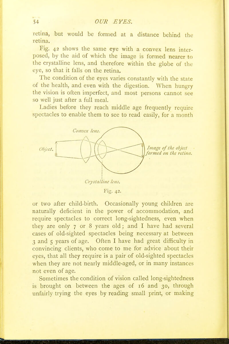 retina, but would be formed at a distance behind the retina. Fig. 42 shows the same eye with a convex lens inter- posed, by the aid of which the image is formed nearer to the crystalline lens, and therefore within the globe of the eye, so that it falls on the retina. The condition of the eyes varies constantly with the state of the health, and even with the digestion. When hungry the vision is often imperfect, and most persons cannot see so well just after a full meal. Ladies before they reach middle age frequently require spectacles to enable them to see to read easily, for a month or two after child-birth. Occasionally young children are naturally deficient in the power of accommodation, and require spectacles to correct long-sightedness, even when they are only 7 or 8 years old; and I have had several cases of old-sighted spectacles being necessary at between 3 and 5 years of age. Often I have had great difficulty in convincing clients, who come to me for advice about their eyes, that all they require is a pair of old-sighted spectacles when they are not nearly middle-aged, or in many instances not even of age. Sometimes the condition of vision called long-sightedness is brought on between the ages of 16 and 30, through unfairly trying the eyes by reading small print, or making Object. I Image of the object ' formed on the retina. Crystalline lens. Fig. 42.