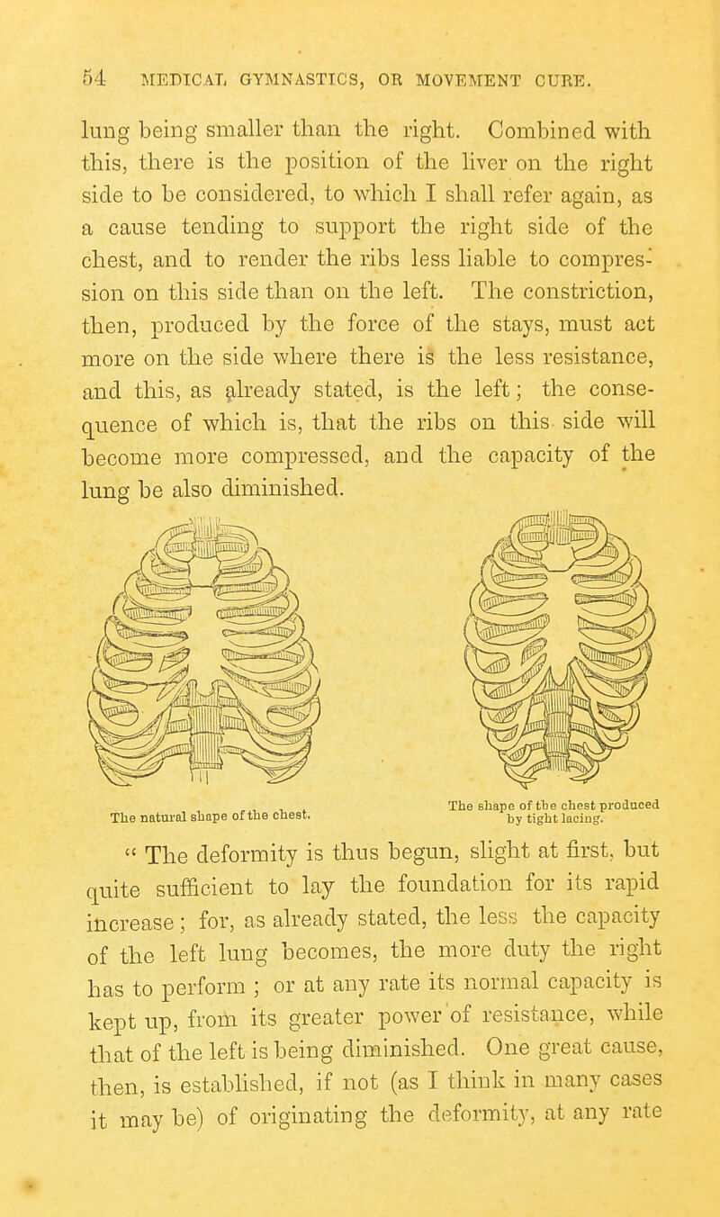 lung being smaller than the right. Combined with this, there is the position of the liver on the right side to be considered, to which I shall refer again, as a cause tending to support the right side of the chest, and to render the ribs less liable to compres- sion on this side than on the left. The constriction, then, produced by the force of the stays, must act more on the side where there is the less resistance, and this, as §ilready stated, is the left; the conse- quence of which is, that the ribs on this side will become more compressed, and the capacity of the lung be also diminished. The shape of til e chest prodnced The natural shape of the chest. tigj^j jacing.  The deformity is thus begun, slight at first, but quite sufficient to lay the foundation for its rapid increase; for, as already stated, the less the capacity of the left lung becomes, the more duty the right has to perform ; or at any rate its normal capacity is kept up, froiti its greater power of resistance, while that of the left is being diminished. One great cause, then, is estabUshed, if not (as I think in many cases it may be) of originating the deformity, at any rate