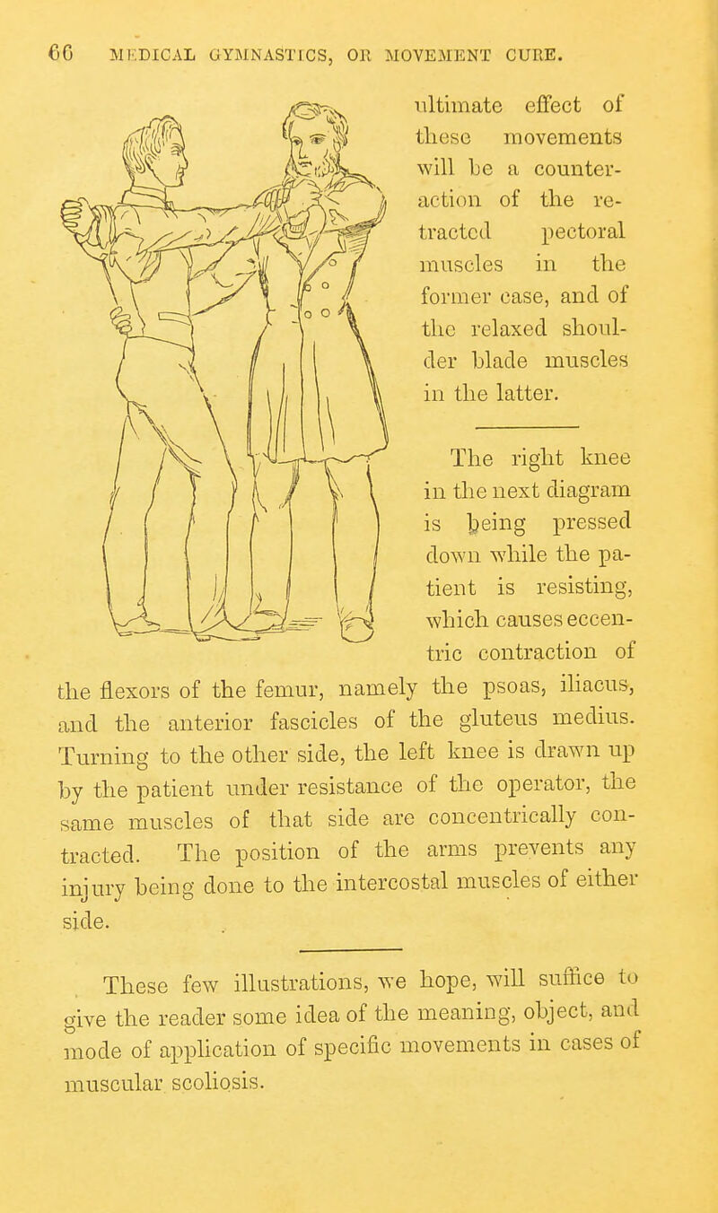 ultimate effect of tliese movements will lie a counter- action of the re- tracted pectoral muscles in the former case, and of the relaxed shoul- der blade muscles in the latter. The right knee in the next diagram is feeing pressed down while the pa- tient is resisting, which causes eccen- tric contraction of the flexors of the femur, namely the psoas, ihacus, and the anterior fascicles of the gluteus medius. Turning to the other side, the left knee is drawn up by the patient under resistance of the operator, the same muscles of that side are concentrically con- tracted. The position of the arms prevents any injury being done to the intercostal muscles of either side. These few illustrations, we hope, will suffice to give the reader some idea of the meaning, object, and mode of apphcation of specific movements in cases of muscular scoliosis.