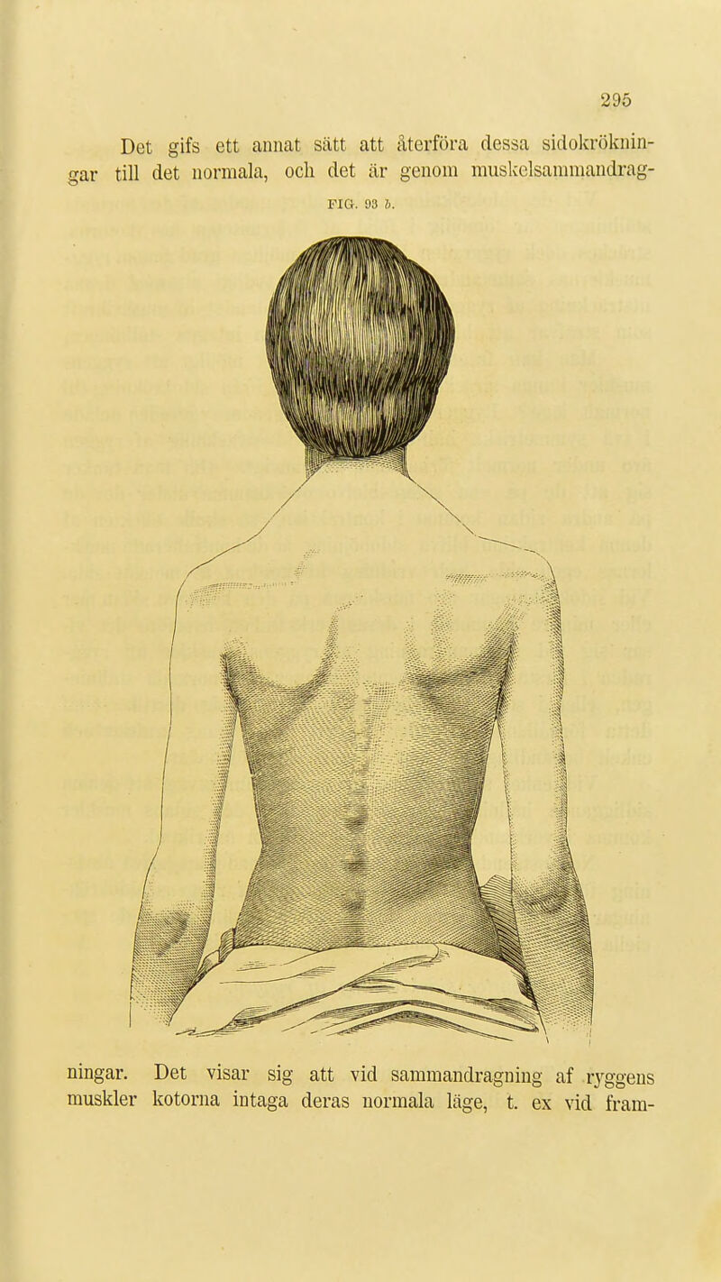 Det gifs ett annat sätt att återföra dessa sidokröknin- gar till det normala, och det är genom muskelsammandrag- FIG. 93 i. ningar. Det visar sig att vid sammandragning af ryggens muskler kotorna intaga deras normala läge, t. ex vid fram-