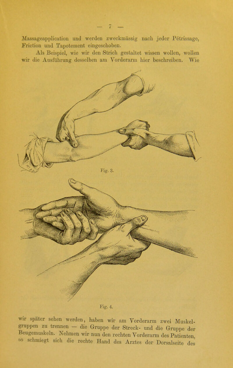 Massageap[)lication und werden zweckmässig nach jeder Petrissage, Frictiou und Tapoteraent eingeschoben. Als Beispiel, wie wir den Strich gestaltet wissen wollen, wollen wir die Ausführung desselben am Vorderarm hier beschreiben. Wie Fig. 4. wir später sehen werden, haben wir am Vorderarm zwei Muskel- gruppen zu trennen - die Gruppe der Streck- und die Gruppe der Beugemuskeln. Nehmen wir nun den rechten Vorderarm des Patienten so schmiegt sich die rechte Hand des Arztes der Dorsalseite des